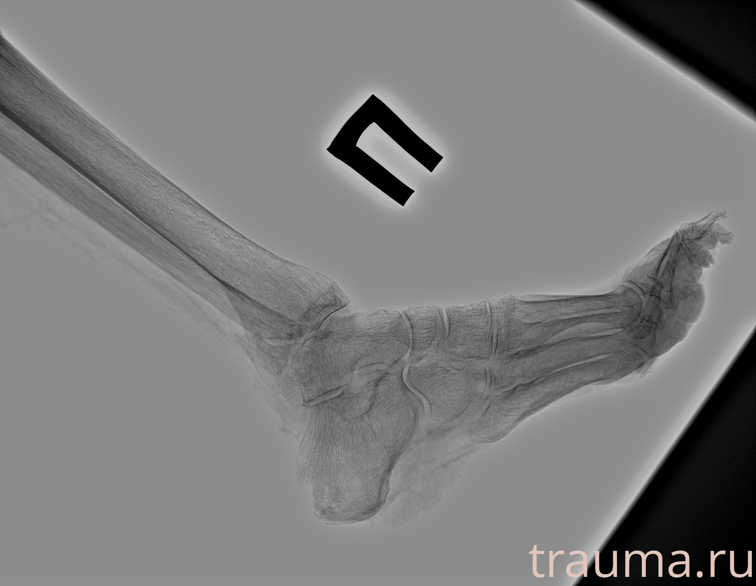 Рентген на дому: по вашему адресу приезжает врач-рентгенолог, травматолог-ортопед с мобильным рентгеновским аппаратом, проводит диагностику травмы или заболевания, делает необходимые рентгенограммы, дает рекомендации по дальнейшему лечению. Получить качественные снимки в домашних условиях возможно благодаря уникальной методике, разработанной МосРентген Центром для института  Склифосовского