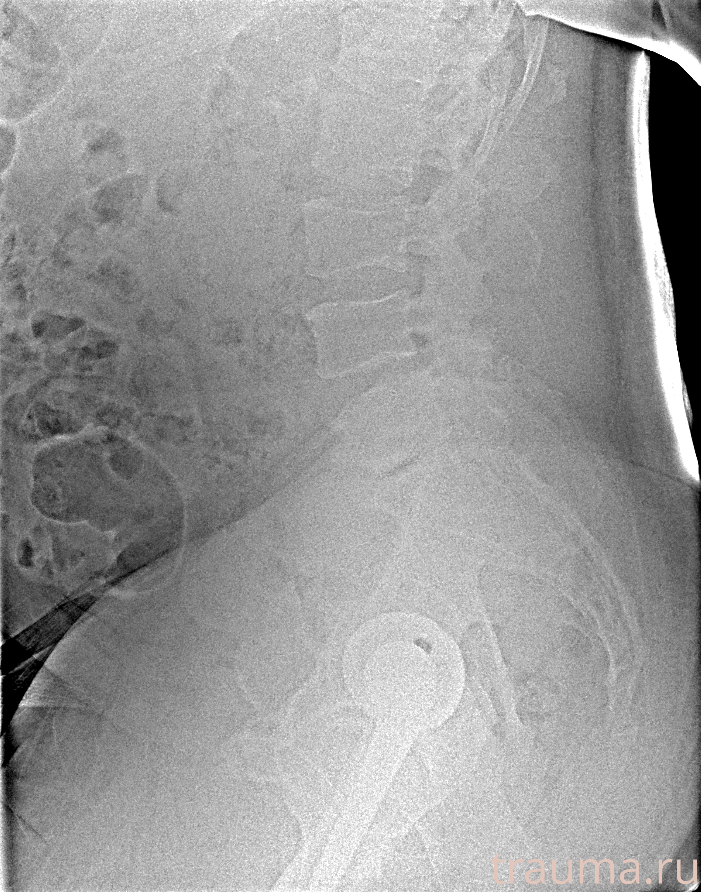 Рентген на дому: по вашему адресу приезжает врач-рентгенолог, травматолог-ортопед с мобильным рентгеновским аппаратом, проводит диагностику травмы или заболевания, делает необходимые рентгенограммы, дает рекомендации по дальнейшему лечению. Получить качественные снимки в домашних условиях возможно благодаря уникальной методике, разработанной МосРентген Центром для института  Склифосовского
