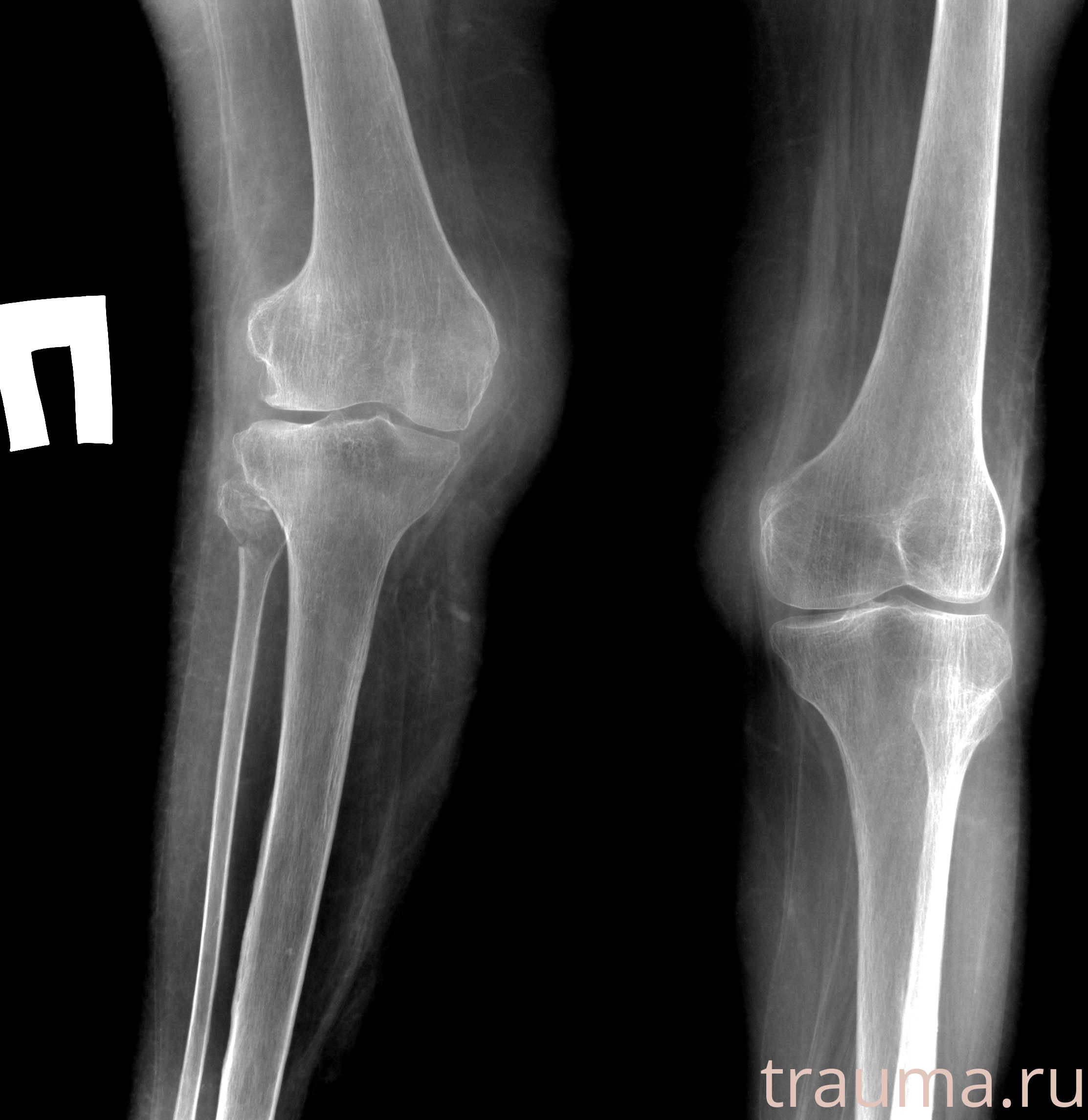 Рентген на дому: по вашему адресу приезжает врач-рентгенолог, травматолог-ортопед с мобильным рентгеновским аппаратом, проводит диагностику травмы или заболевания, делает необходимые рентгенограммы, дает рекомендации по дальнейшему лечению. Получить качественные снимки в домашних условиях возможно благодаря уникальной методике, разработанной МосРентген Центром для института  Склифосовского