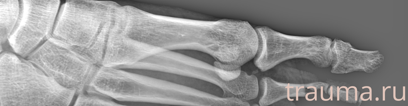 Рентген на дому: по вашему адресу приезжает врач-рентгенолог, травматолог-ортопед с мобильным рентгеновским аппаратом, проводит диагностику травмы или заболевания, делает необходимые рентгенограммы, дает рекомендации по дальнейшему лечению. Получить качественные снимки в домашних условиях возможно благодаря уникальной методике, разработанной МосРентген Центром для института  Склифосовского