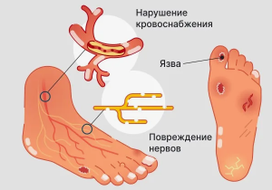 Поражение  ангиосомных зон стопы и риск высокой ампутации при синдроме диабетической стопы 
