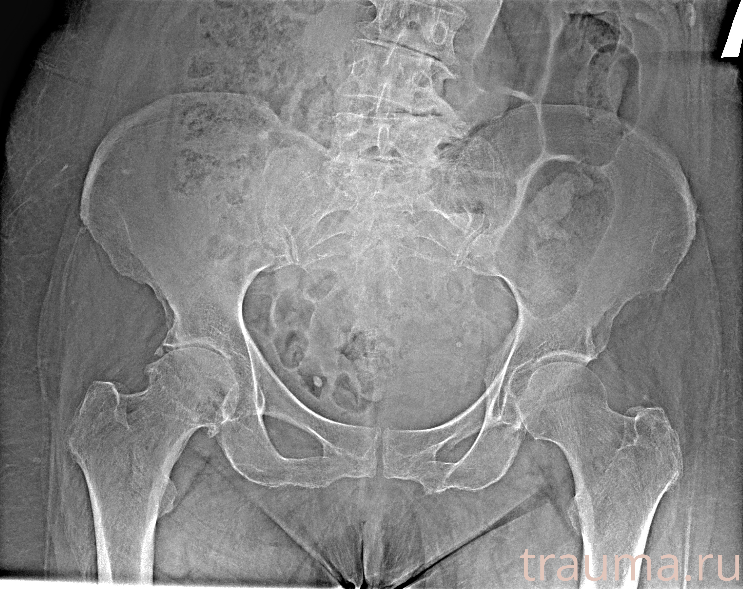 Рентген на дому: по вашему адресу приезжает врач-рентгенолог, травматолог-ортопед с мобильным рентгеновским аппаратом, проводит диагностику травмы или заболевания, делает необходимые рентгенограммы, дает рекомендации по дальнейшему лечению. Получить качественные снимки в домашних условиях возможно благодаря уникальной методике, разработанной МосРентген Центром для института  Склифосовского