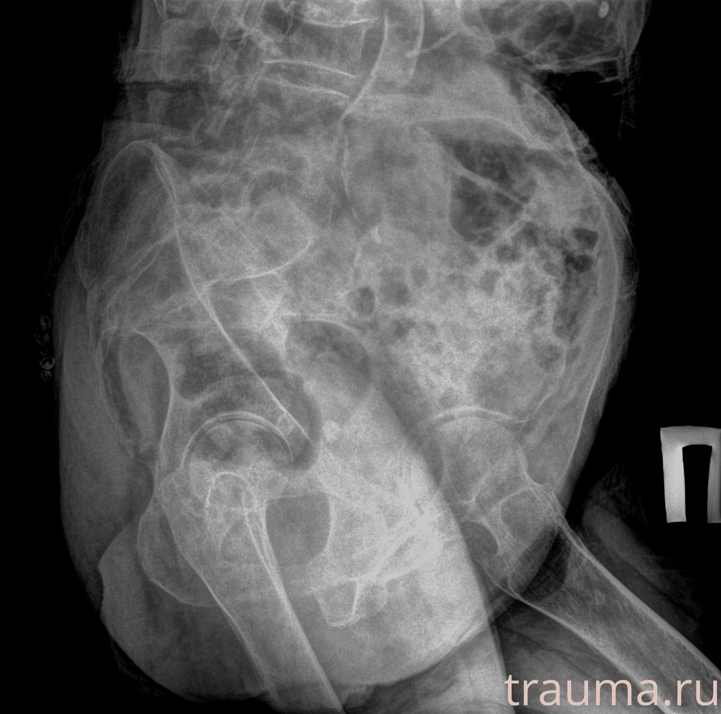 Рентген на дому: по вашему адресу приезжает врач-рентгенолог, травматолог-ортопед с мобильным рентгеновским аппаратом, проводит диагностику травмы или заболевания, делает необходимые рентгенограммы, дает рекомендации по дальнейшему лечению. Получить качественные снимки в домашних условиях возможно благодаря уникальной методике, разработанной МосРентген Центром для института  Склифосовского