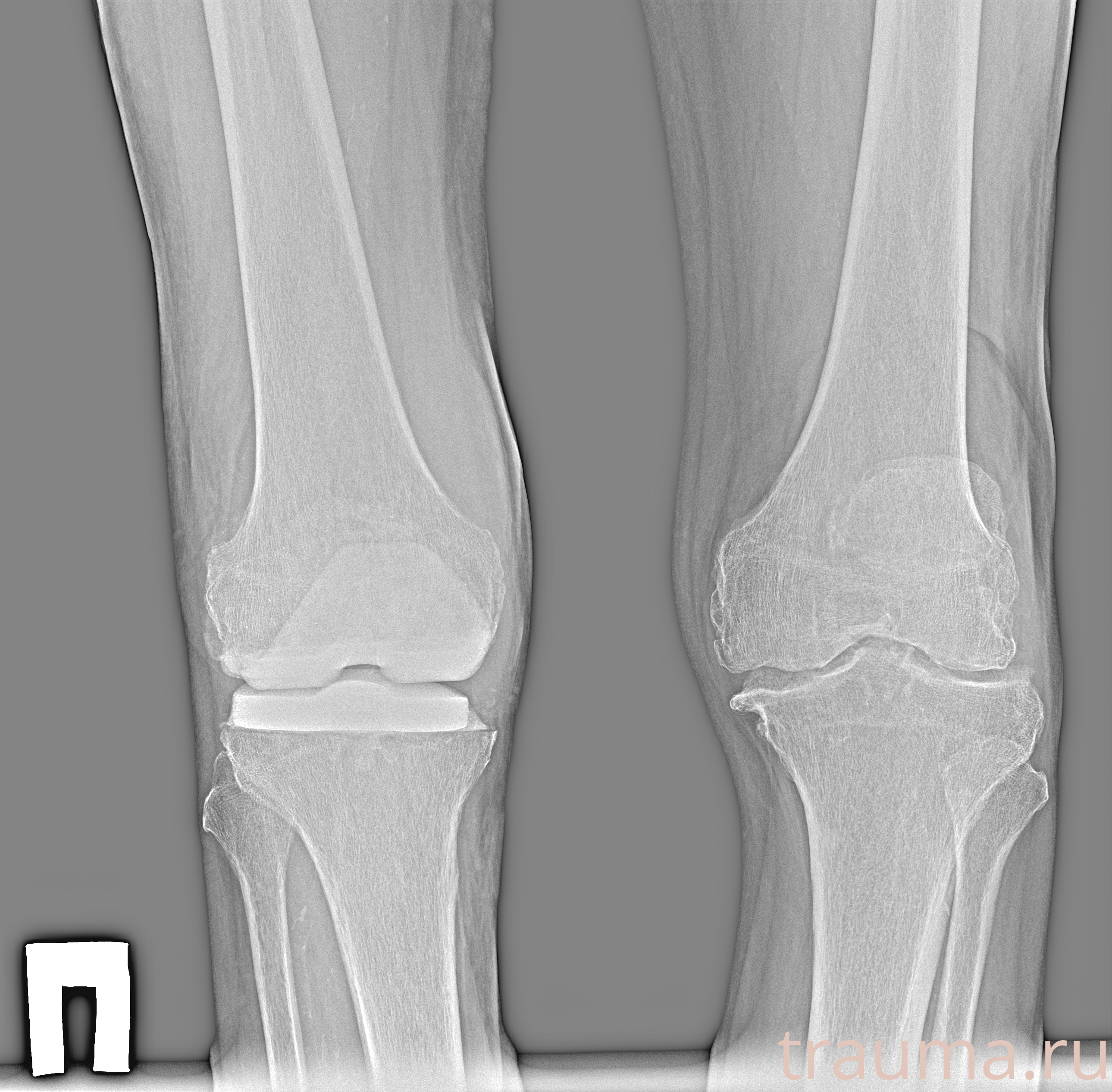 Рентген на дому: по вашему адресу приезжает врач-рентгенолог, травматолог-ортопед с мобильным рентгеновским аппаратом, проводит диагностику травмы или заболевания, делает необходимые рентгенограммы, дает рекомендации по дальнейшему лечению. Получить качественные снимки в домашних условиях возможно благодаря уникальной методике, разработанной МосРентген Центром для института  Склифосовского