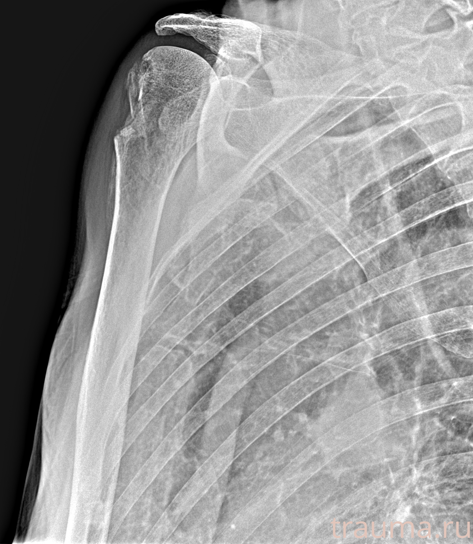 Рентген на дому: по вашему адресу приезжает врач-рентгенолог, травматолог-ортопед с мобильным рентгеновским аппаратом, проводит диагностику травмы или заболевания, делает необходимые рентгенограммы, дает рекомендации по дальнейшему лечению. Получить качественные снимки в домашних условиях возможно благодаря уникальной методике, разработанной МосРентген Центром для института  Склифосовского