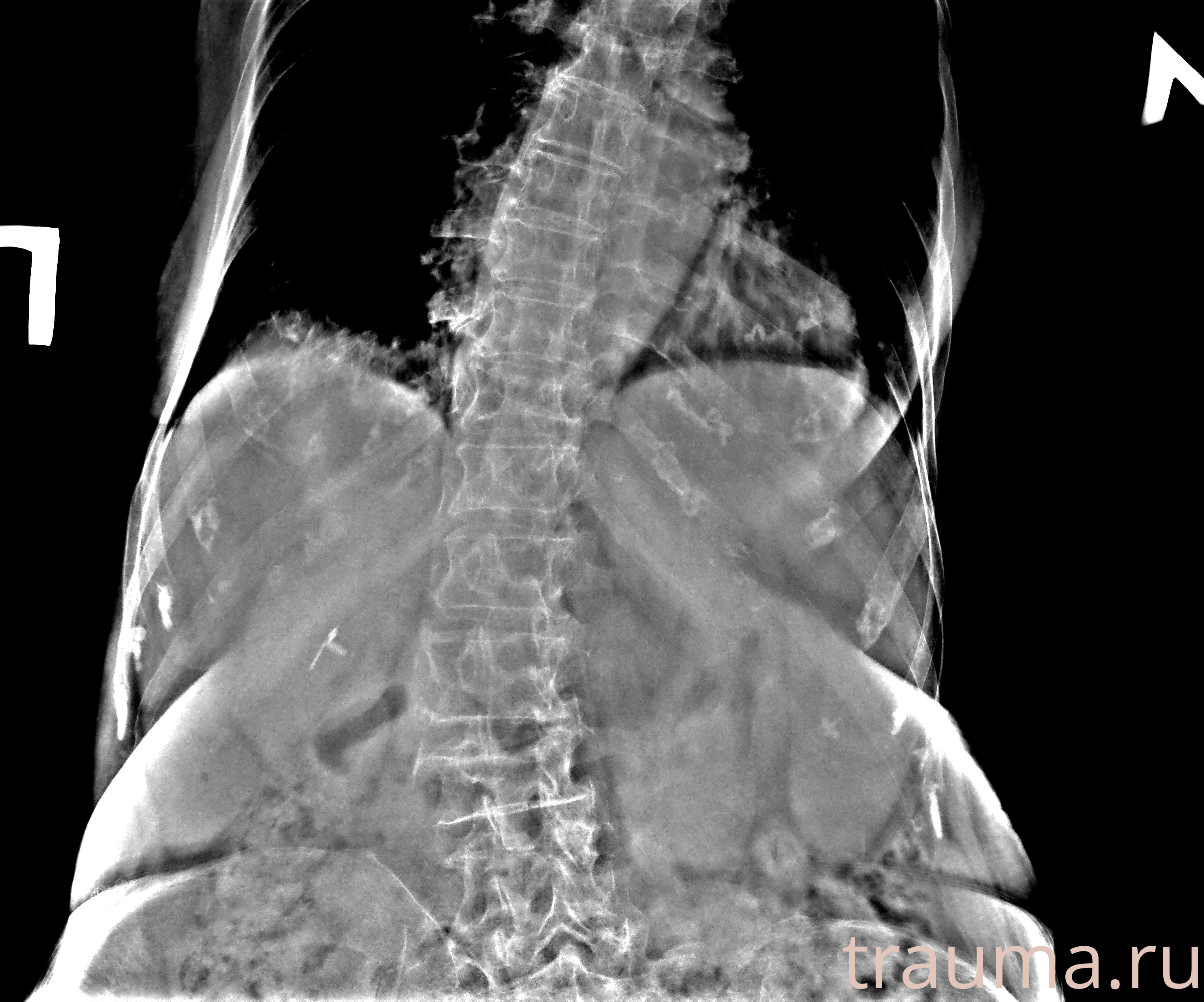 Рентген на дому: по вашему адресу приезжает врач-рентгенолог, травматолог-ортопед с мобильным рентгеновским аппаратом, проводит диагностику травмы или заболевания, делает необходимые рентгенограммы, дает рекомендации по дальнейшему лечению. Получить качественные снимки в домашних условиях возможно благодаря уникальной методике, разработанной МосРентген Центром для института  Склифосовского