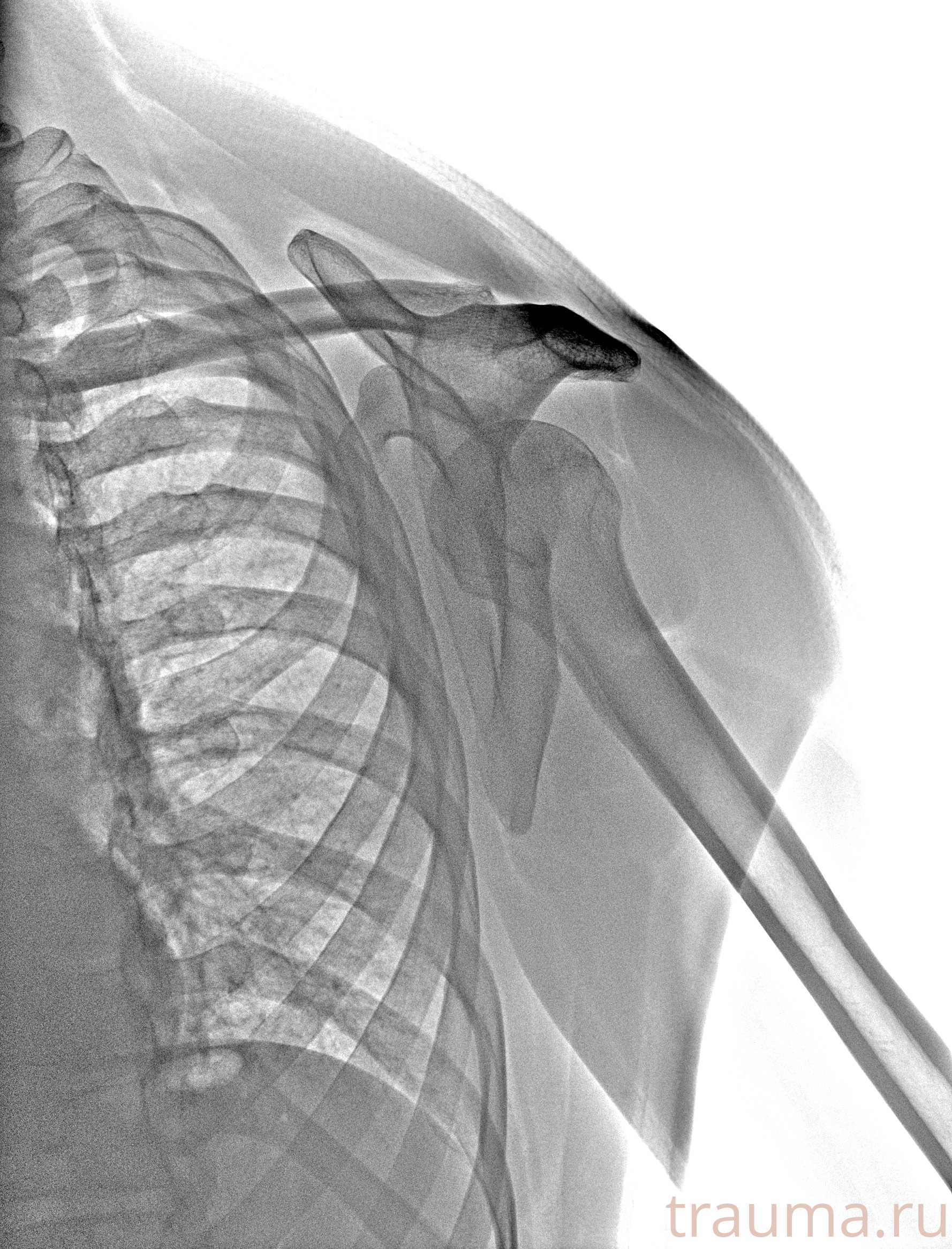 Рентген на дому: по вашему адресу приезжает врач-рентгенолог, травматолог-ортопед с мобильным рентгеновским аппаратом, проводит диагностику травмы или заболевания, делает необходимые рентгенограммы, дает рекомендации по дальнейшему лечению. Получить качественные снимки в домашних условиях возможно благодаря уникальной методике, разработанной МосРентген Центром для института  Склифосовского