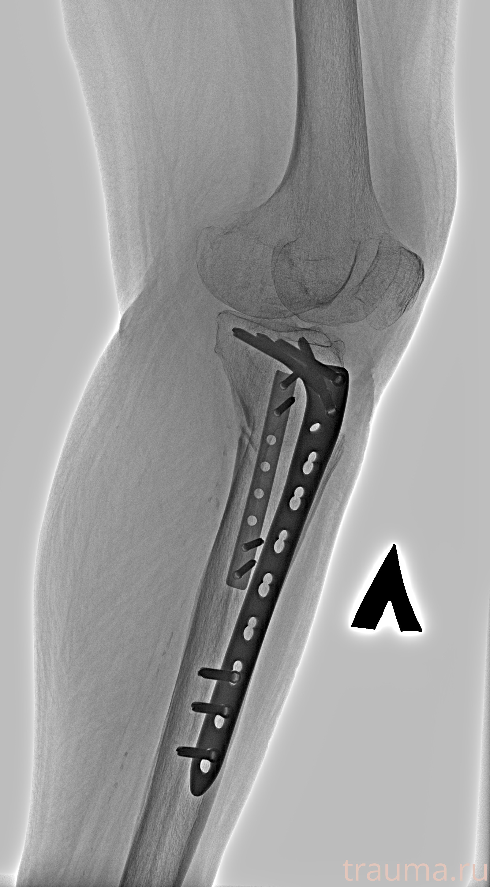 Рентген на дому: по вашему адресу приезжает врач-рентгенолог, травматолог-ортопед с мобильным рентгеновским аппаратом, проводит диагностику травмы или заболевания, делает необходимые рентгенограммы, дает рекомендации по дальнейшему лечению. Получить качественные снимки в домашних условиях возможно благодаря уникальной методике, разработанной МосРентген Центром для института  Склифосовского