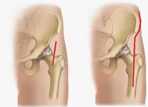 Влияние расширенного предоперационного обследования на выбор тактики лечения перед вторым этапом ревизионного эндопротезирования тазобедренного сустава