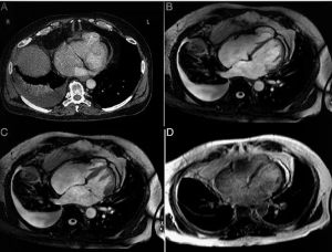 Магнитно-резонансная томография сердца — точный метод диагностики поражений миокарда с низкой доступностью в отделениях неотложной кардиологии