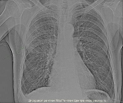 Как выглядит отравление ФОС на рентгенограмме грудной клетки