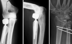 Хирургическое лечение хронической продольной лучелоктевой диссоциации предплечья (повреждение Эссекс-Лопрести)
