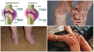 Морфорентгенометрическая диагностика остеоартроза коленного сустава у больных пожилого возраста
