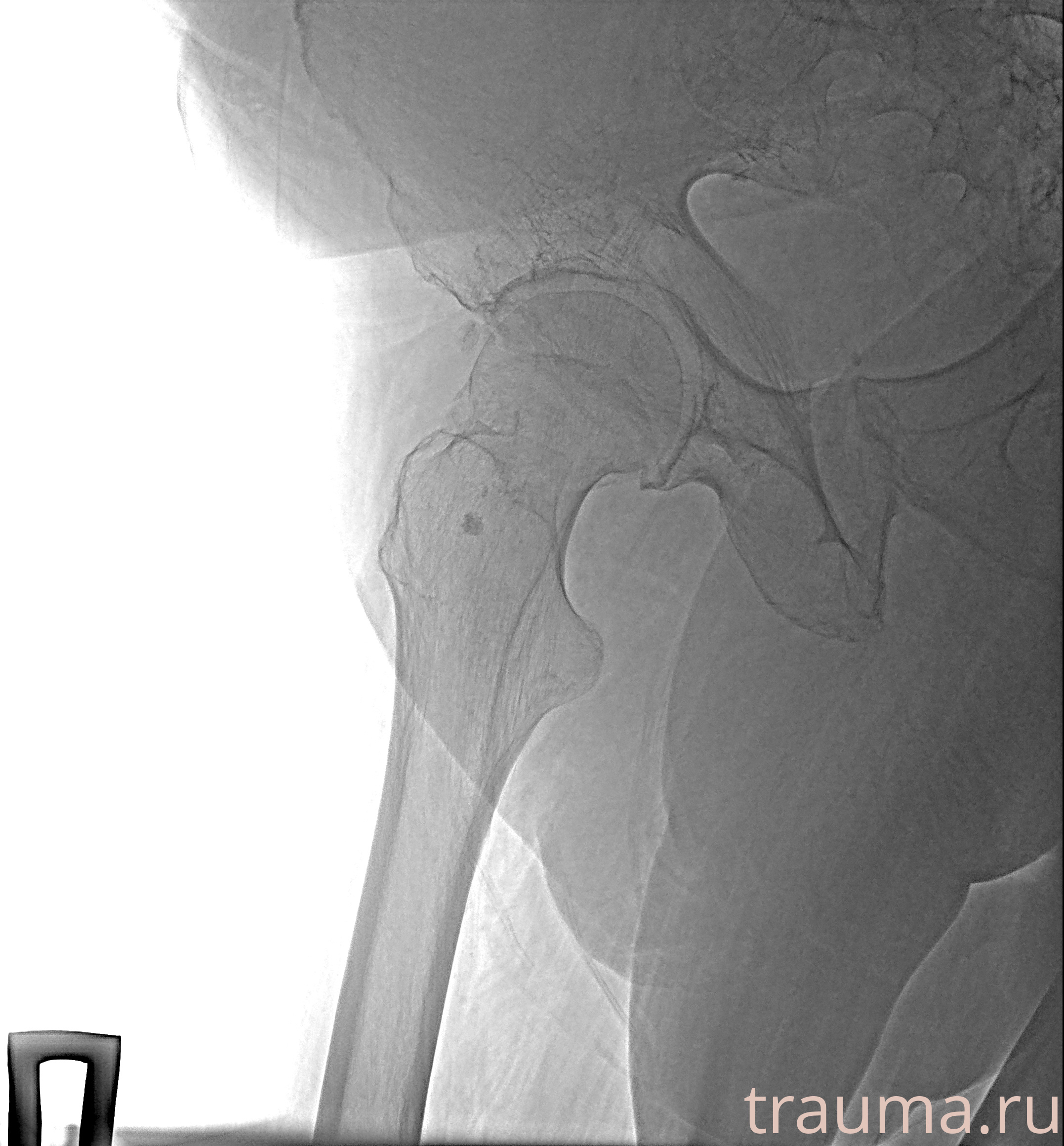 Рентген на дому: по вашему адресу приезжает врач-рентгенолог, травматолог-ортопед с мобильным рентгеновским аппаратом, проводит диагностику травмы или заболевания, делает необходимые рентгенограммы, дает рекомендации по дальнейшему лечению. Получить качественные снимки в домашних условиях возможно благодаря уникальной методике, разработанной МосРентген Центром для института  Склифосовского