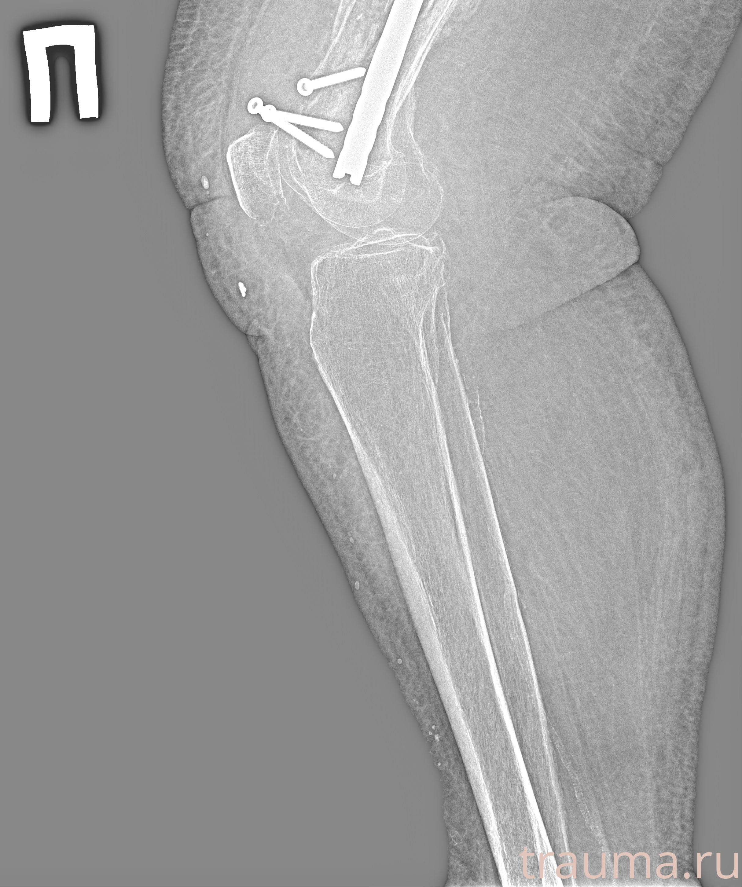 Рентген на дому: по вашему адресу приезжает врач-рентгенолог, травматолог-ортопед с мобильным рентгеновским аппаратом, проводит диагностику травмы или заболевания, делает необходимые рентгенограммы, дает рекомендации по дальнейшему лечению. Получить качественные снимки в домашних условиях возможно благодаря уникальной методике, разработанной МосРентген Центром для института  Склифосовского