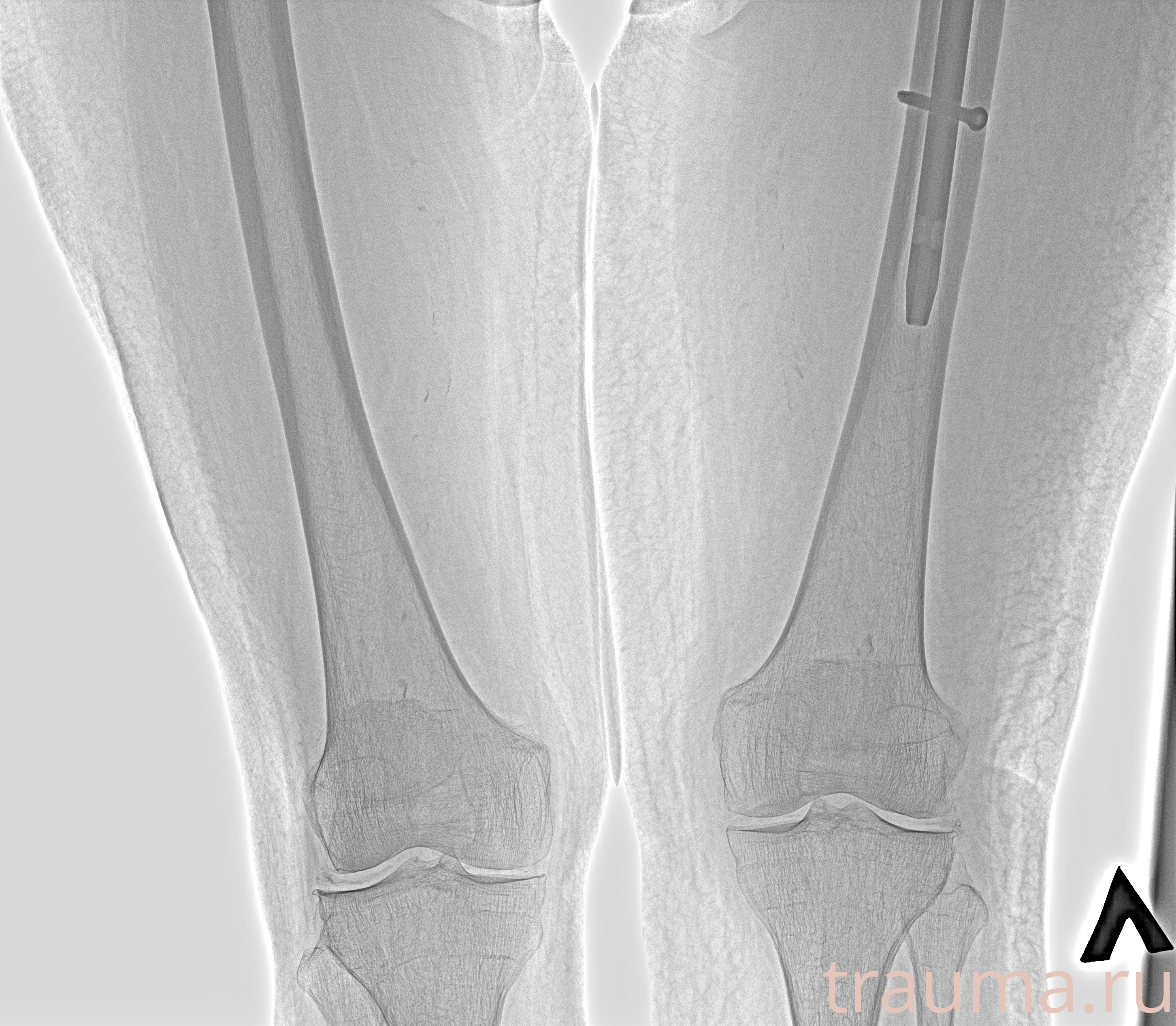 Рентген на дому: по вашему адресу приезжает врач-рентгенолог, травматолог-ортопед с мобильным рентгеновским аппаратом, проводит диагностику травмы или заболевания, делает необходимые рентгенограммы, дает рекомендации по дальнейшему лечению. Получить качественные снимки в домашних условиях возможно благодаря уникальной методике, разработанной МосРентген Центром для института  Склифосовского