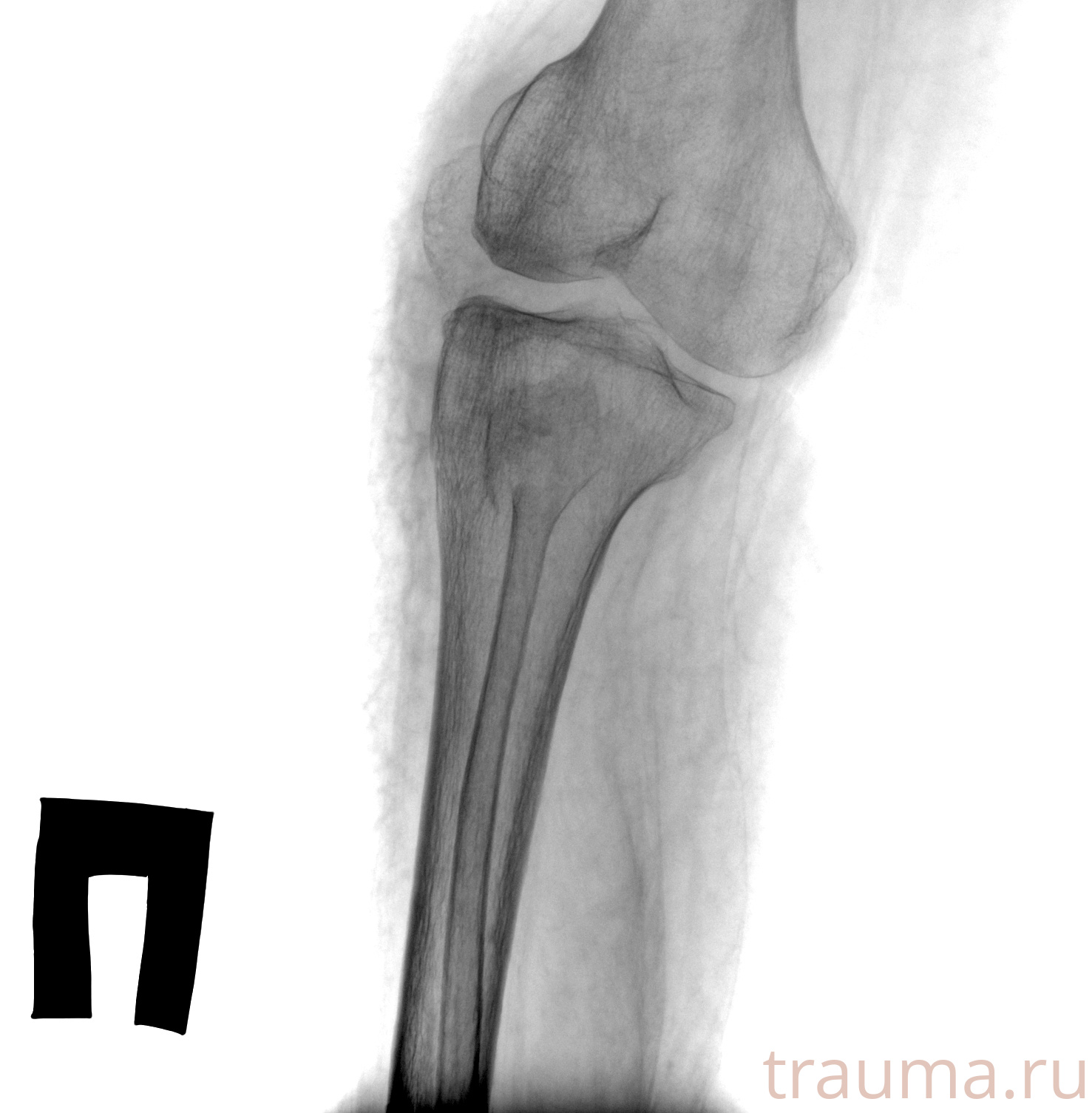 Рентген на дому: по вашему адресу приезжает врач-рентгенолог, травматолог-ортопед с мобильным рентгеновским аппаратом, проводит диагностику травмы или заболевания, делает необходимые рентгенограммы, дает рекомендации по дальнейшему лечению. Получить качественные снимки в домашних условиях возможно благодаря уникальной методике, разработанной МосРентген Центром для института  Склифосовского