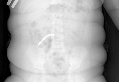 Врачи были в шоке, взглянув на рентген 2-летнего ребенка