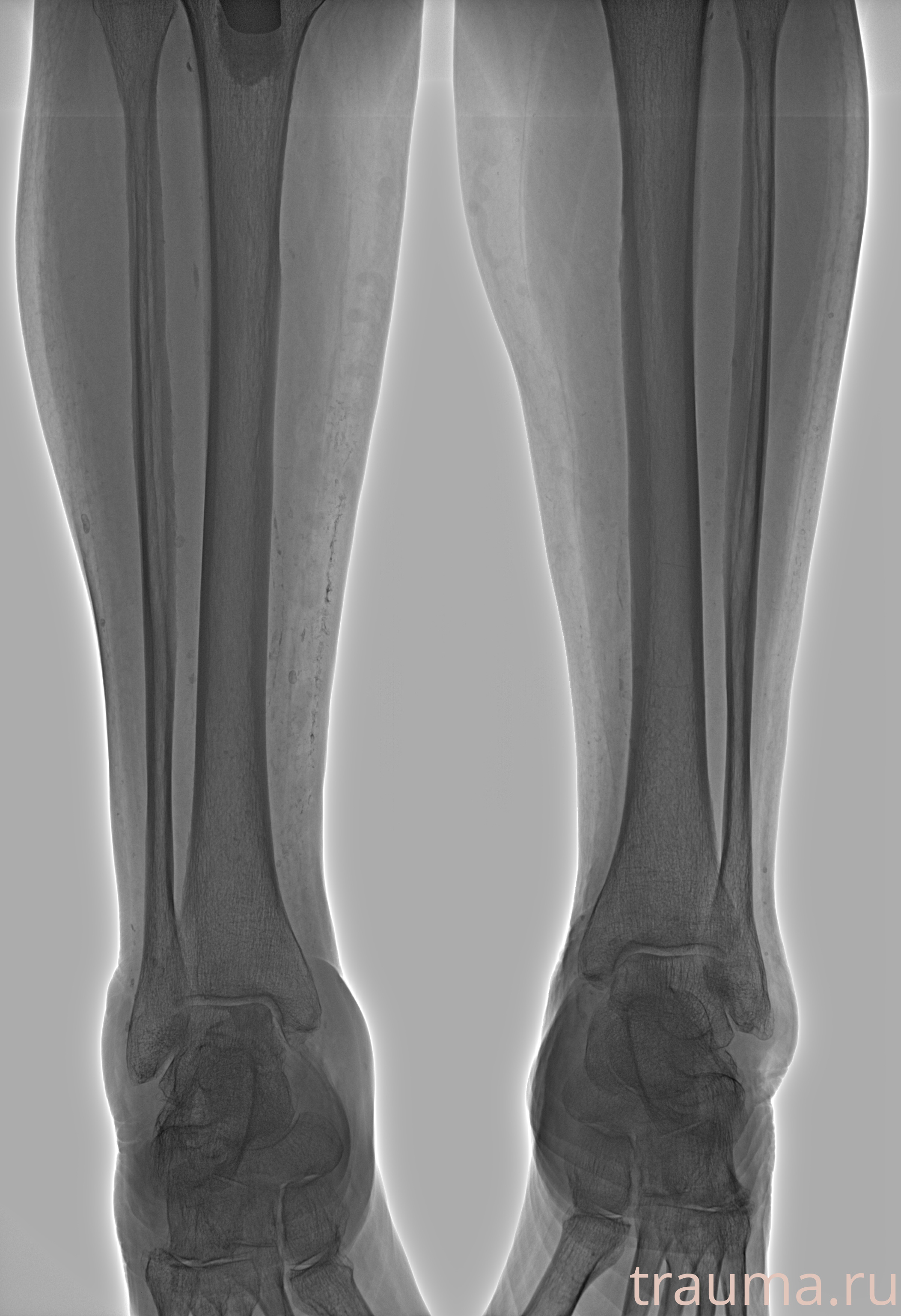 Рентген на дому: по вашему адресу приезжает врач-рентгенолог, травматолог-ортопед с мобильным рентгеновским аппаратом, проводит диагностику травмы или заболевания, делает необходимые рентгенограммы, дает рекомендации по дальнейшему лечению. Получить качественные снимки в домашних условиях возможно благодаря уникальной методике, разработанной МосРентген Центром для института  Склифосовского