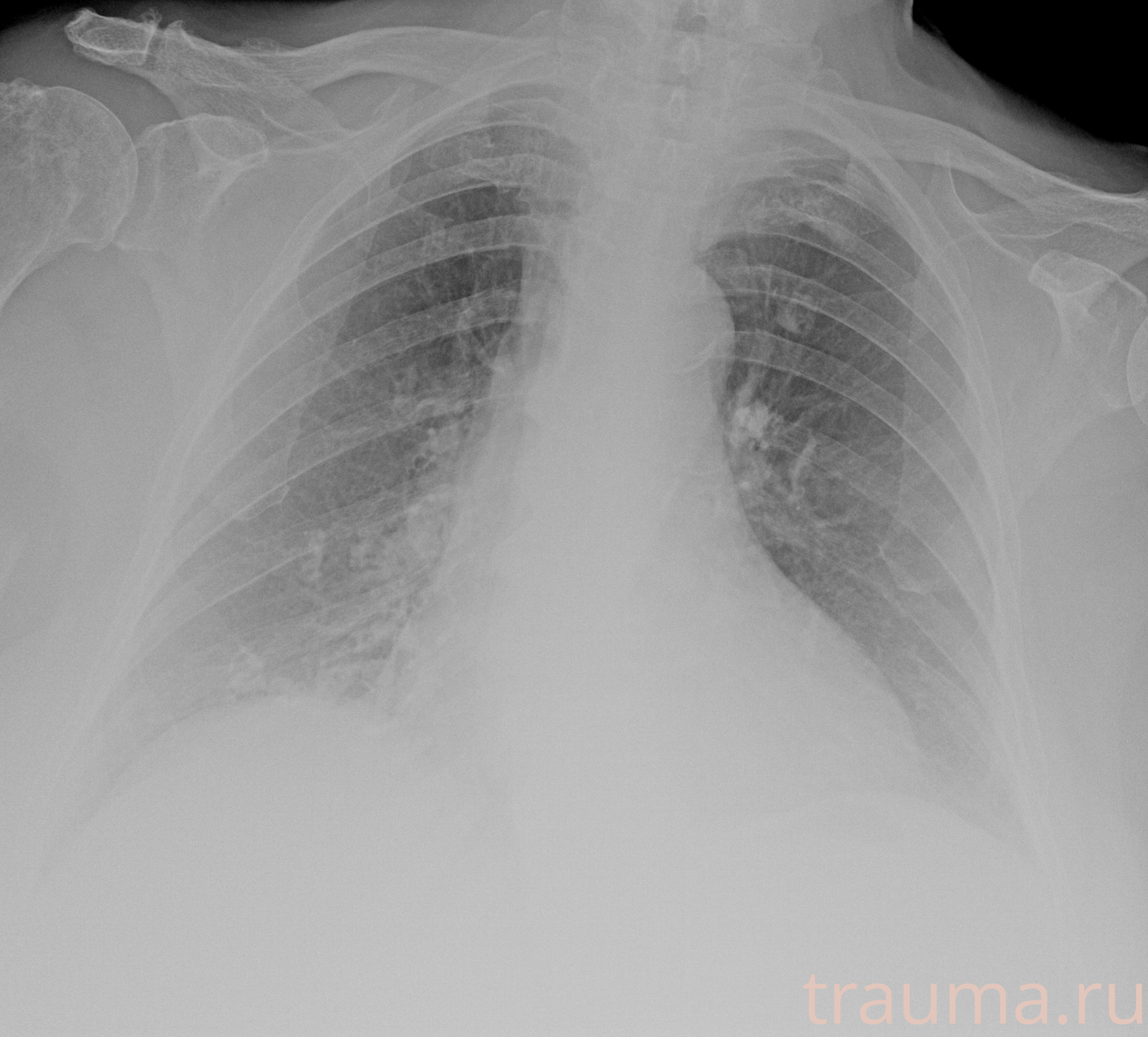 Рентген на дому: по вашему адресу приезжает врач-рентгенолог, травматолог-ортопед с мобильным рентгеновским аппаратом, проводит диагностику травмы или заболевания, делает необходимые рентгенограммы, дает рекомендации по дальнейшему лечению. Получить качественные снимки в домашних условиях возможно благодаря уникальной методике, разработанной МосРентген Центром для института  Склифосовского