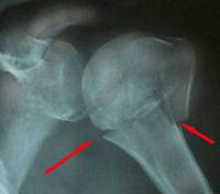 Особенности чрескостного остеосинтеза по Илизарову при лечении переломов плечевой кости у детей