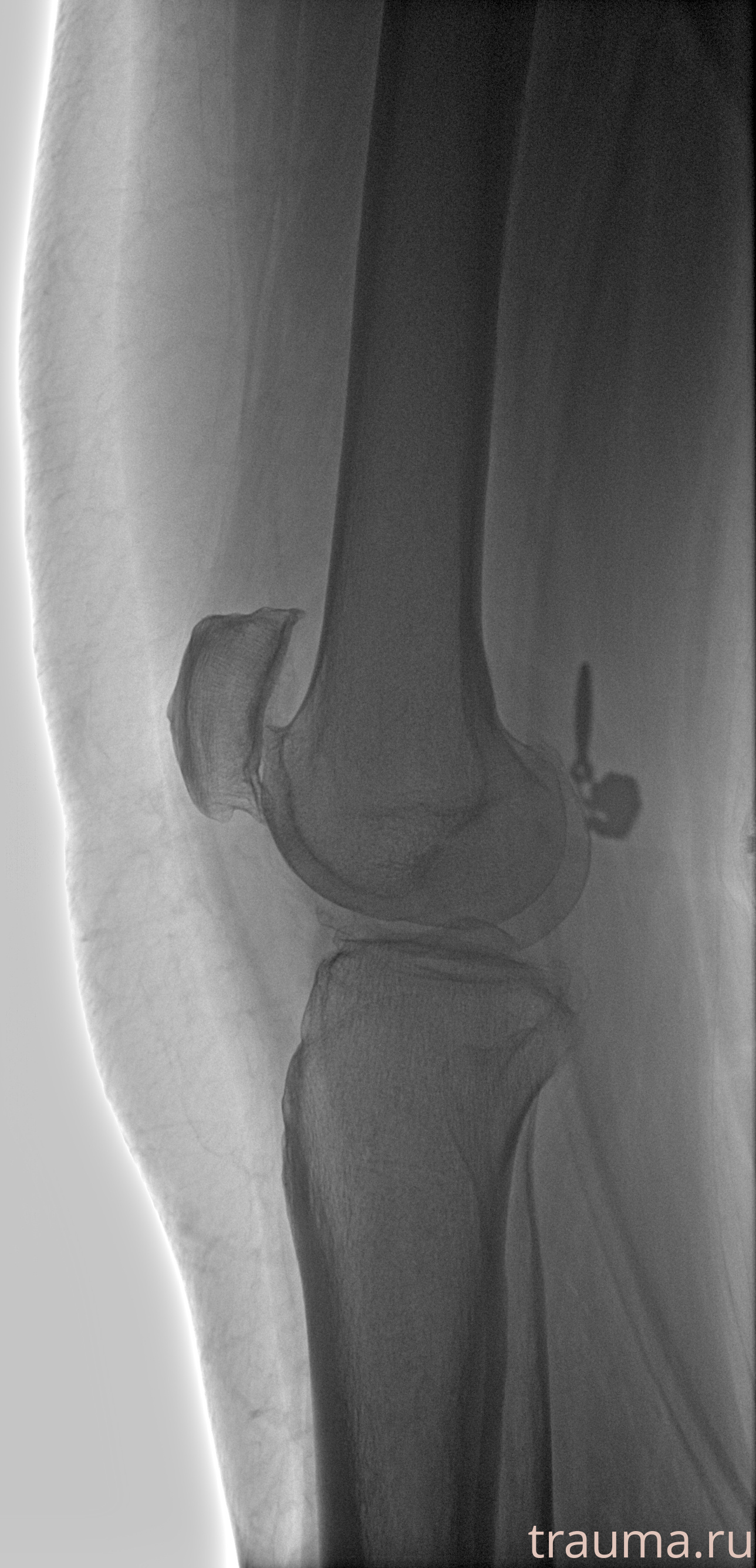 Рентген на дому: по вашему адресу приезжает врач-рентгенолог, травматолог-ортопед с мобильным рентгеновским аппаратом, проводит диагностику травмы или заболевания, делает необходимые рентгенограммы, дает рекомендации по дальнейшему лечению. Получить качественные снимки в домашних условиях возможно благодаря уникальной методике, разработанной МосРентген Центром для института  Склифосовского