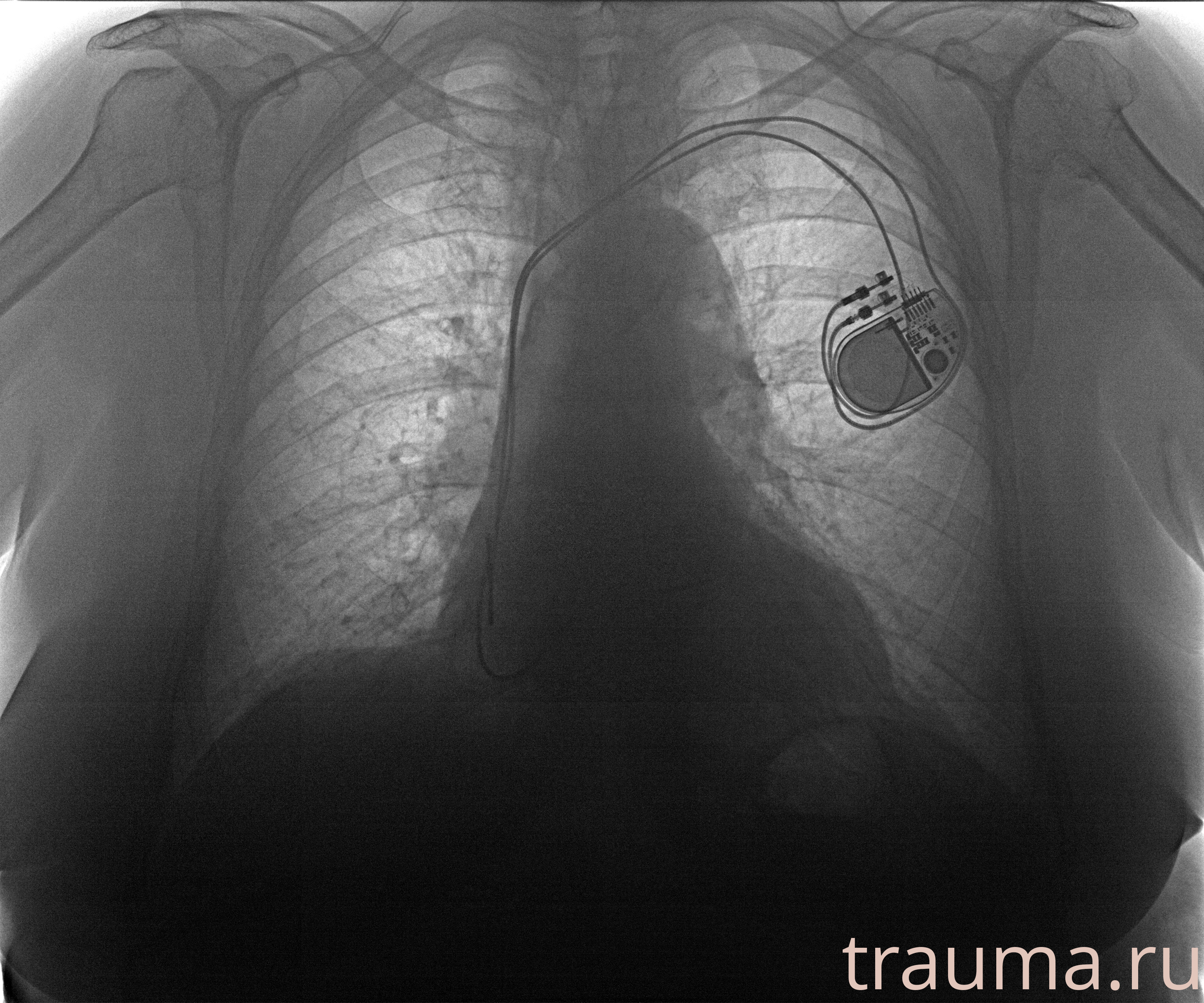 Рентген на дому: по вашему адресу приезжает врач-рентгенолог, травматолог-ортопед с мобильным рентгеновским аппаратом, проводит диагностику травмы или заболевания, делает необходимые рентгенограммы, дает рекомендации по дальнейшему лечению. Получить качественные снимки в домашних условиях возможно благодаря уникальной методике, разработанной МосРентген Центром для института  Склифосовского