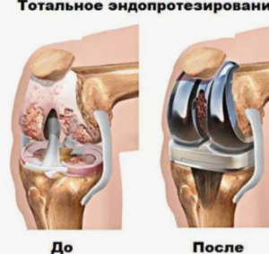 Клинико-функциональный и нейропсихологический статус пациентов, поступивших на эндопротезирование суставов
