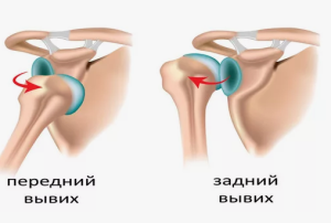 Выявление и профилактика типичных травм спортсменов: вывихи плечевых суставов