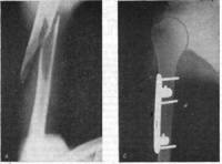 Способы управления осколками при лечении больных с закрытыми диафизарными оскольчатыми переломами длинных трубчатых костей
