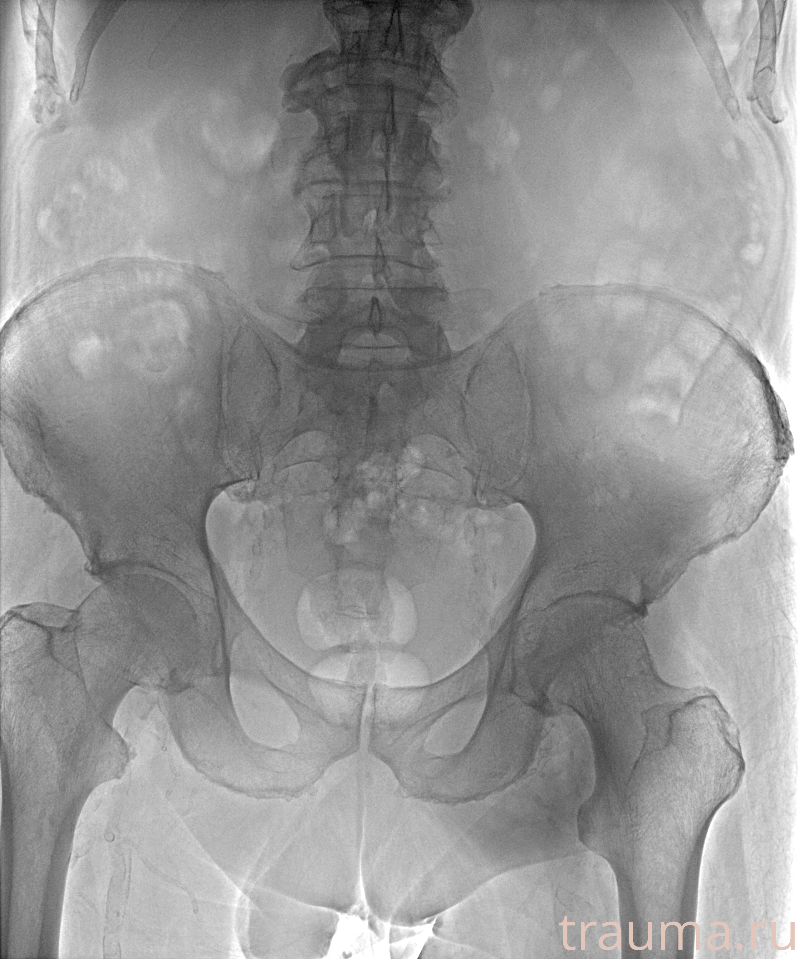 Рентген на дому: по вашему адресу приезжает врач-рентгенолог, травматолог-ортопед с мобильным рентгеновским аппаратом, проводит диагностику травмы или заболевания, делает необходимые рентгенограммы, дает рекомендации по дальнейшему лечению. Получить качественные снимки в домашних условиях возможно благодаря уникальной методике, разработанной МосРентген Центром для института  Склифосовского