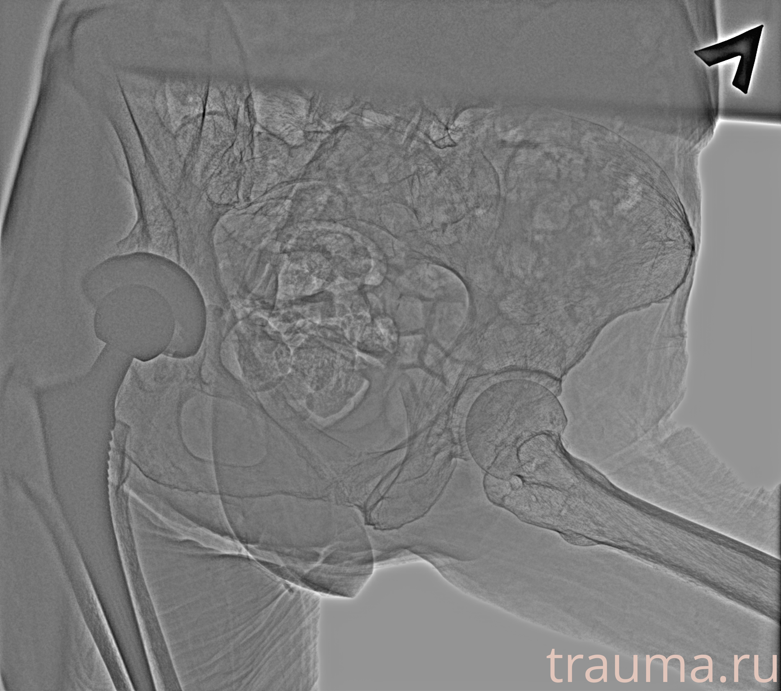 Рентген на дому: по вашему адресу приезжает врач-рентгенолог, травматолог-ортопед с мобильным рентгеновским аппаратом, проводит диагностику травмы или заболевания, делает необходимые рентгенограммы, дает рекомендации по дальнейшему лечению. Получить качественные снимки в домашних условиях возможно благодаря уникальной методике, разработанной МосРентген Центром для института  Склифосовского