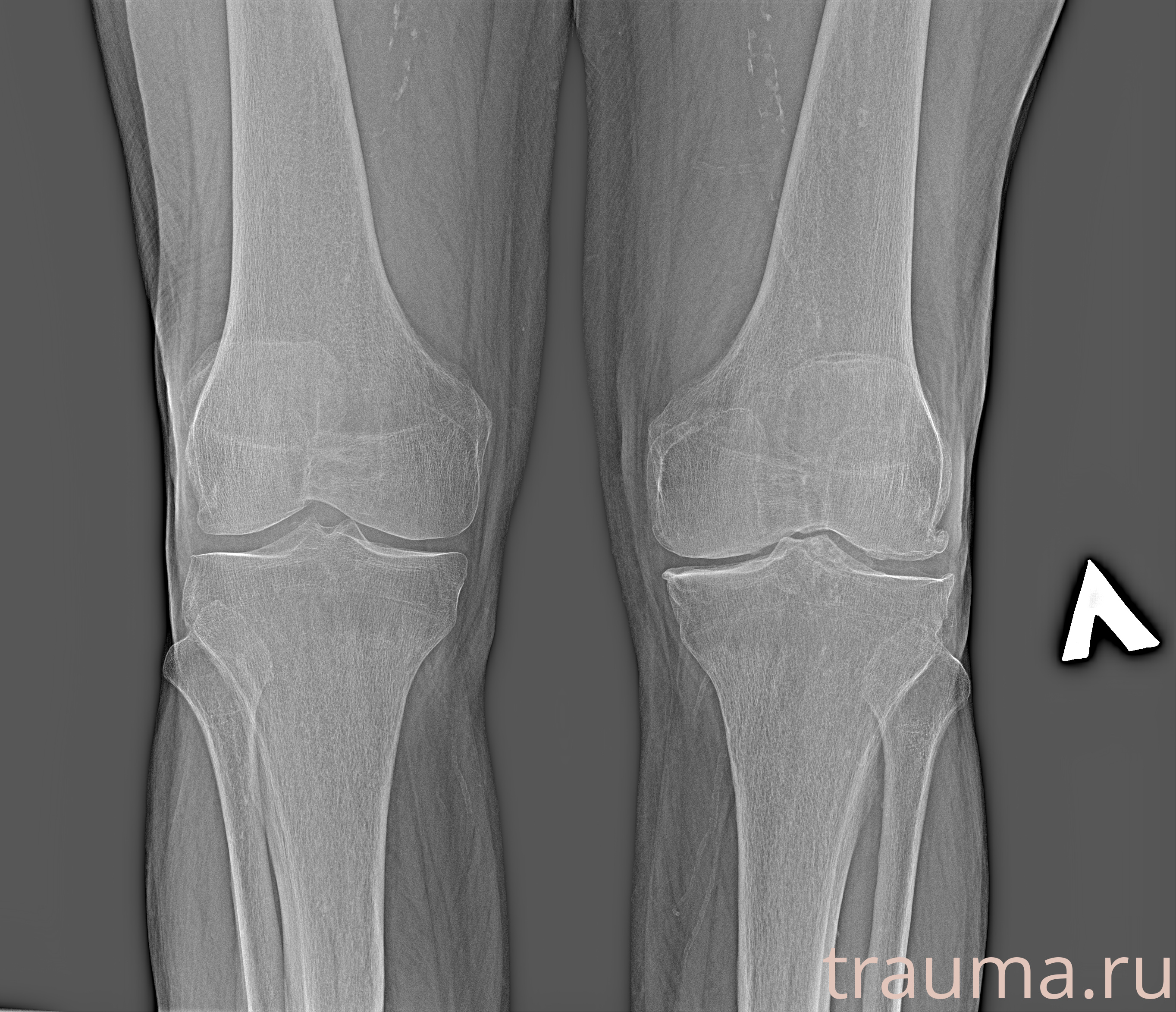 Рентген на дому: по вашему адресу приезжает врач-рентгенолог, травматолог-ортопед с мобильным рентгеновским аппаратом, проводит диагностику травмы или заболевания, делает необходимые рентгенограммы, дает рекомендации по дальнейшему лечению. Получить качественные снимки в домашних условиях возможно благодаря уникальной методике, разработанной МосРентген Центром для института  Склифосовского