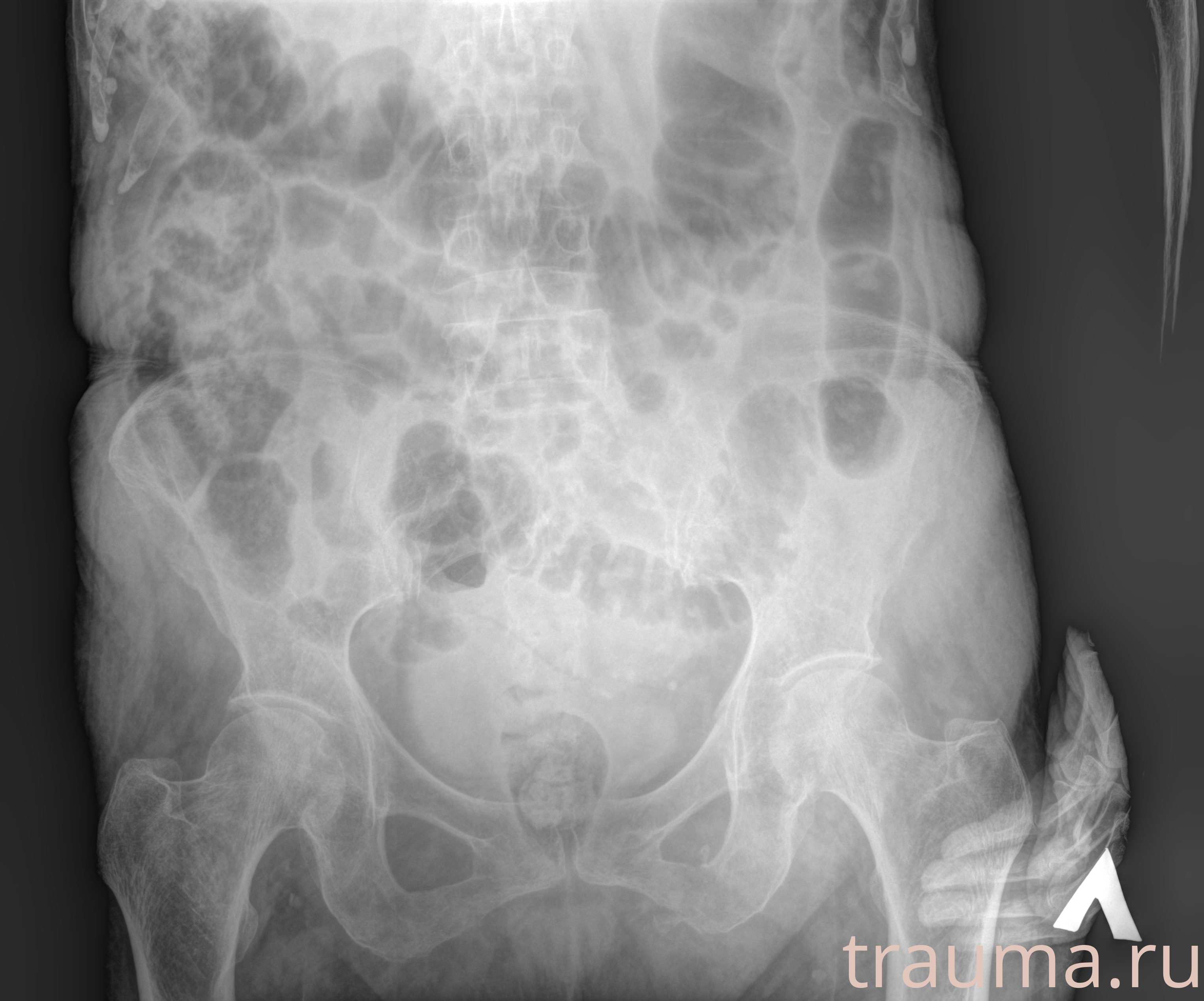 Рентген на дому: по вашему адресу приезжает врач-рентгенолог, травматолог-ортопед с мобильным рентгеновским аппаратом, проводит диагностику травмы или заболевания, делает необходимые рентгенограммы, дает рекомендации по дальнейшему лечению. Получить качественные снимки в домашних условиях возможно благодаря уникальной методике, разработанной МосРентген Центром для института  Склифосовского