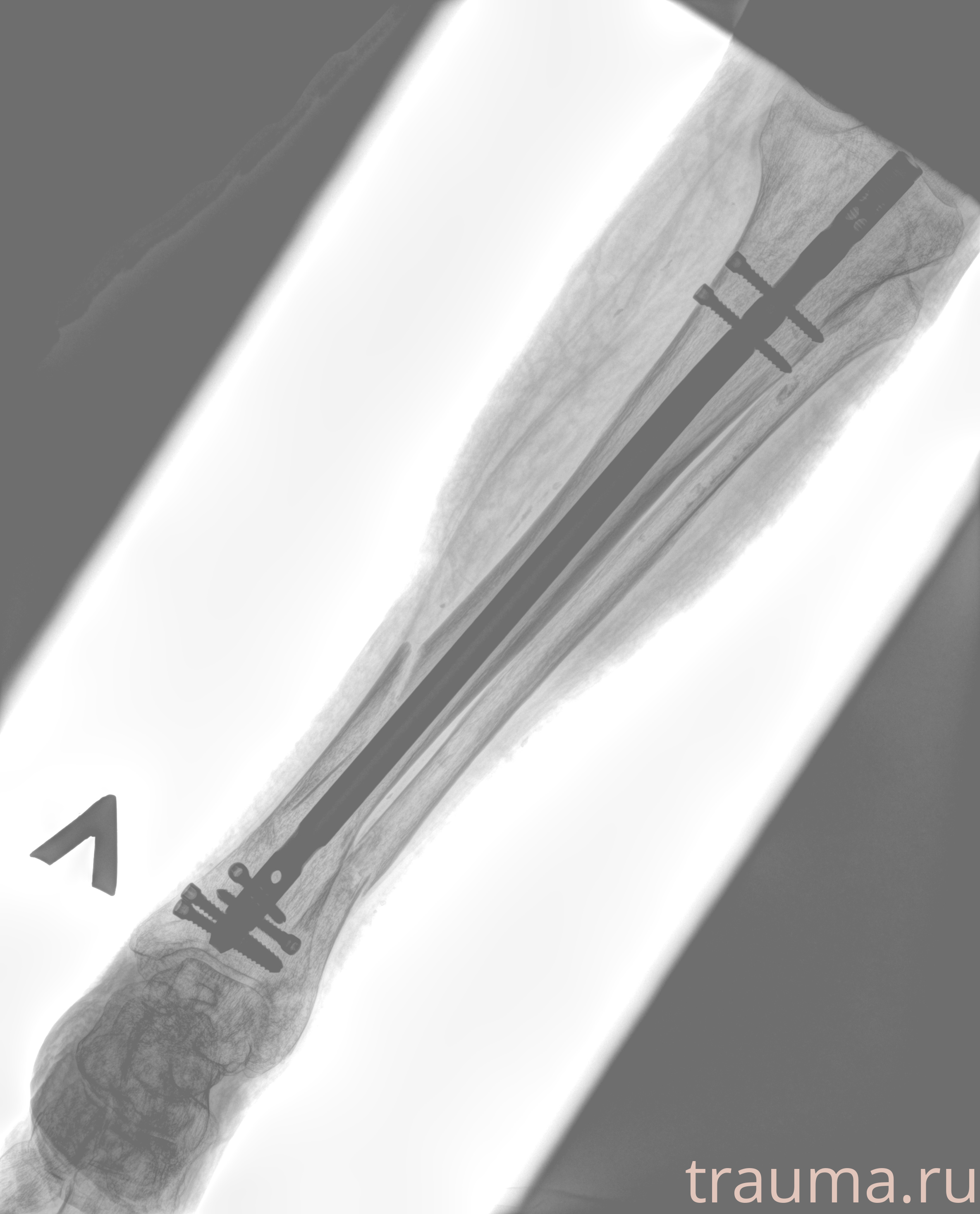 Рентген на дому: по вашему адресу приезжает врач-рентгенолог, травматолог-ортопед с мобильным рентгеновским аппаратом, проводит диагностику травмы или заболевания, делает необходимые рентгенограммы, дает рекомендации по дальнейшему лечению. Получить качественные снимки в домашних условиях возможно благодаря уникальной методике, разработанной МосРентген Центром для института  Склифосовского