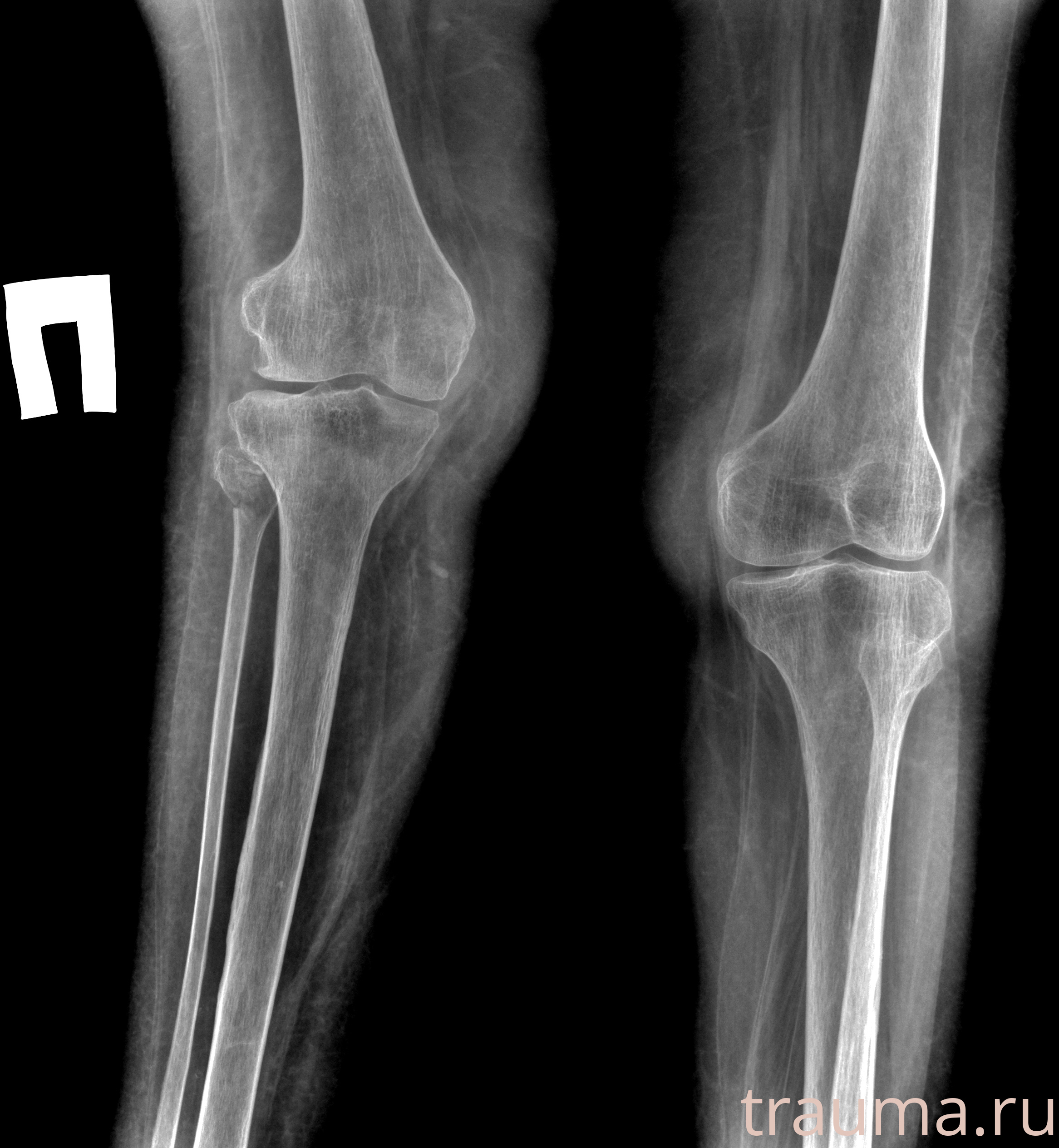 Рентген на дому: по вашему адресу приезжает врач-рентгенолог, травматолог-ортопед с мобильным рентгеновским аппаратом, проводит диагностику травмы или заболевания, делает необходимые рентгенограммы, дает рекомендации по дальнейшему лечению. Получить качественные снимки в домашних условиях возможно благодаря уникальной методике, разработанной МосРентген Центром для института  Склифосовского