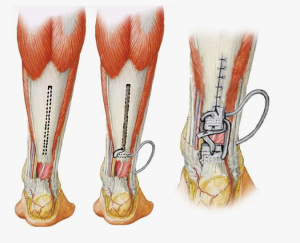 Влияние смещения периферического фрагмента пяточной кости при ее переломе на функцию трехглавой мышцы голени