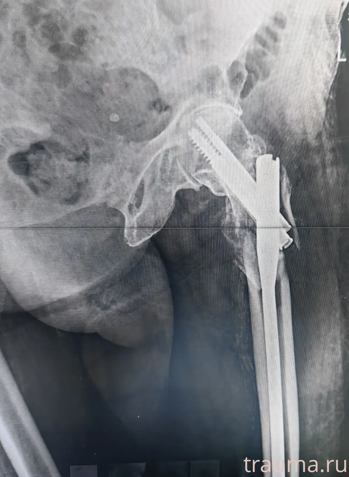 Рентген на дому: по вашему адресу приезжает врач-рентгенолог, травматолог-ортопед с мобильным рентгеновским аппаратом, проводит диагностику травмы или заболевания, делает необходимые рентгенограммы, дает рекомендации по дальнейшему лечению. Получить качественные снимки в домашних условиях возможно благодаря уникальной методике, разработанной МосРентген Центром для института  Склифосовского