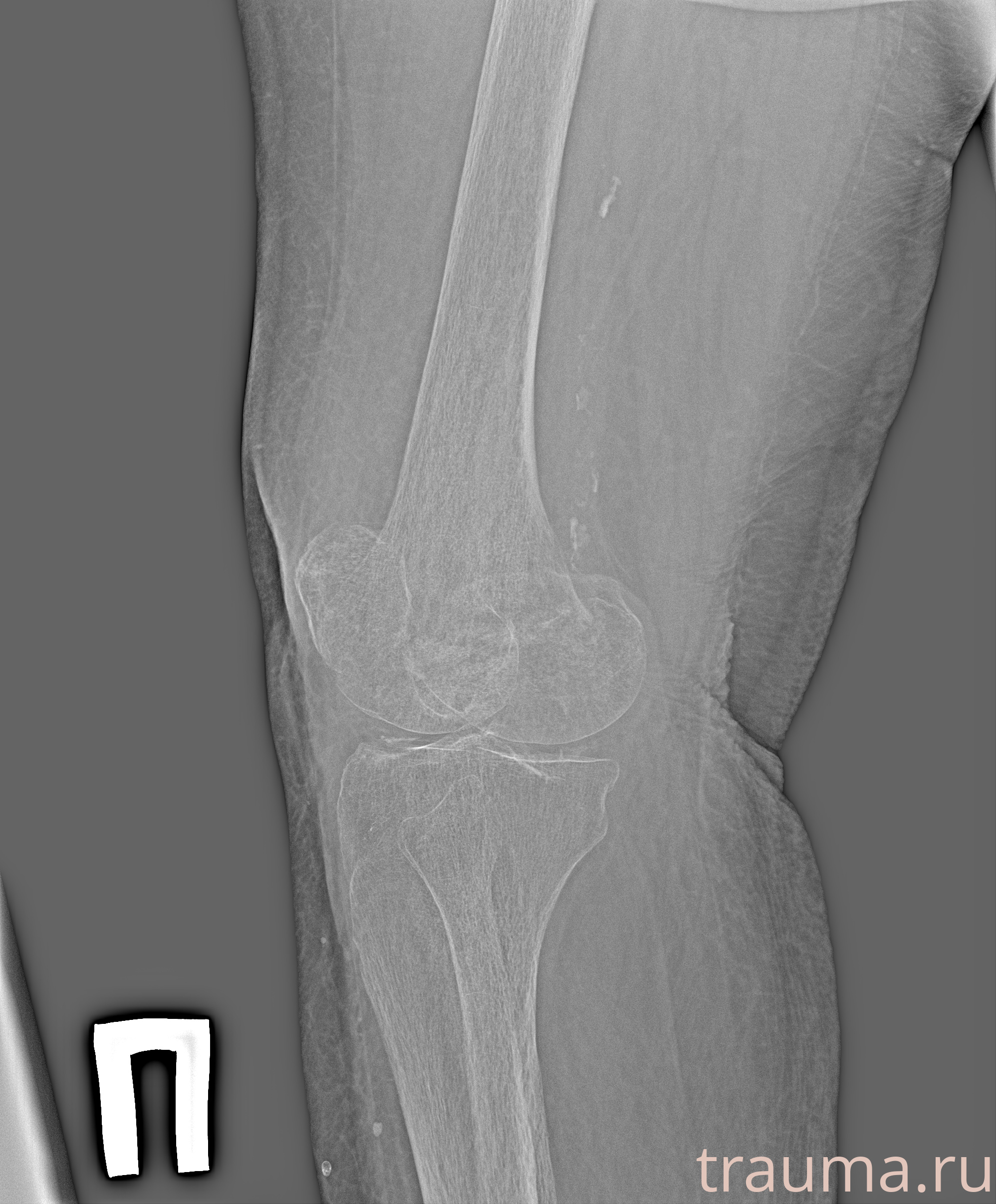 Рентген на дому: по вашему адресу приезжает врач-рентгенолог, травматолог-ортопед с мобильным рентгеновским аппаратом, проводит диагностику травмы или заболевания, делает необходимые рентгенограммы, дает рекомендации по дальнейшему лечению. Получить качественные снимки в домашних условиях возможно благодаря уникальной методике, разработанной МосРентген Центром для института  Склифосовского