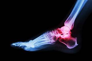 Расширенное рентгенологическое исследование  при повреждениях голеностопного сустава и стопы 