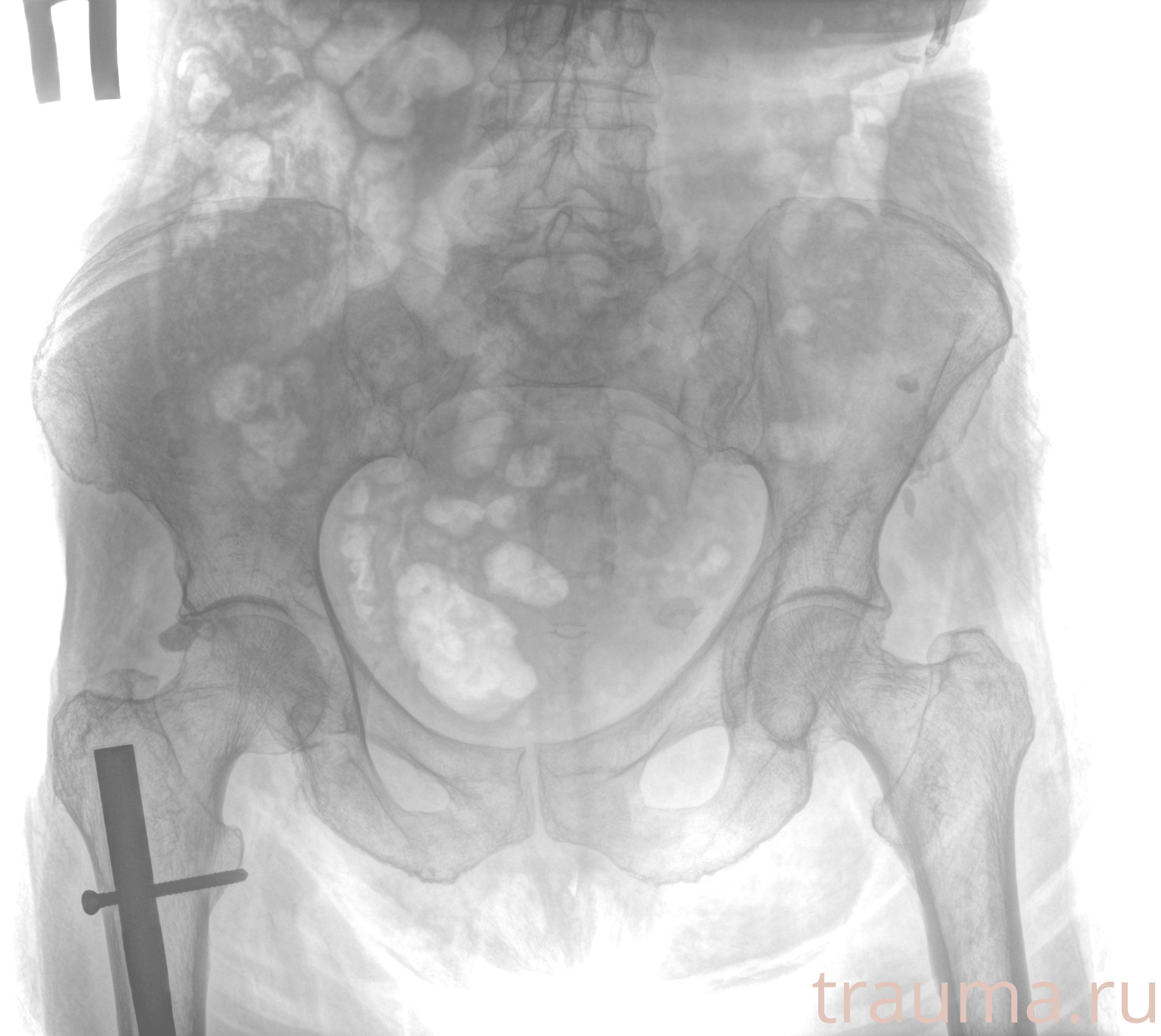 Рентген на дому: по вашему адресу приезжает врач-рентгенолог, травматолог-ортопед с мобильным рентгеновским аппаратом, проводит диагностику травмы или заболевания, делает необходимые рентгенограммы, дает рекомендации по дальнейшему лечению. Получить качественные снимки в домашних условиях возможно благодаря уникальной методике, разработанной МосРентген Центром для института  Склифосовского