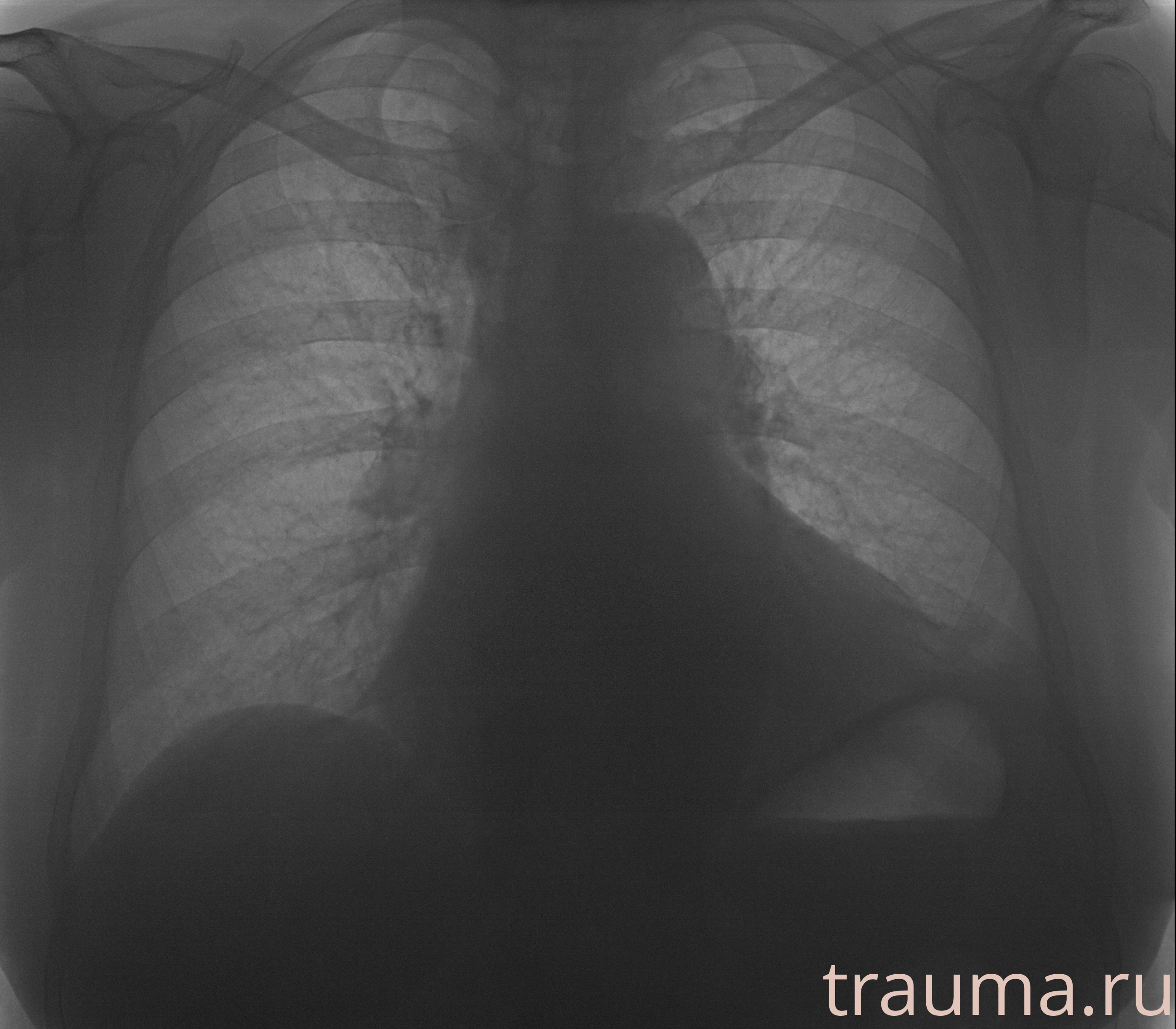 Рентген на дому: по вашему адресу приезжает врач-рентгенолог, травматолог-ортопед с мобильным рентгеновским аппаратом, проводит диагностику травмы или заболевания, делает необходимые рентгенограммы, дает рекомендации по дальнейшему лечению. Получить качественные снимки в домашних условиях возможно благодаря уникальной методике, разработанной МосРентген Центром для института  Склифосовского