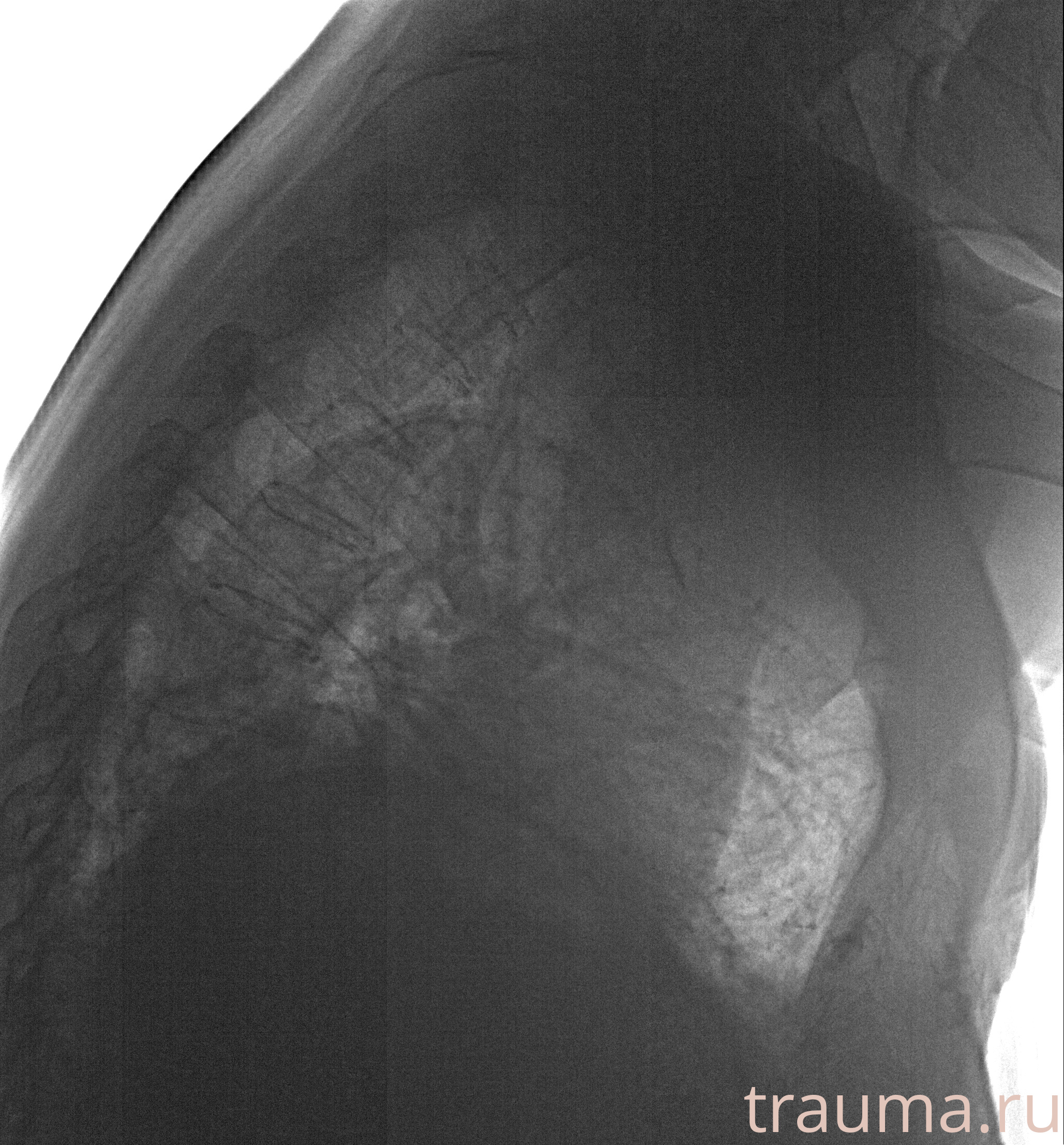 Рентген на дому: по вашему адресу приезжает врач-рентгенолог, травматолог-ортопед с мобильным рентгеновским аппаратом, проводит диагностику травмы или заболевания, делает необходимые рентгенограммы, дает рекомендации по дальнейшему лечению. Получить качественные снимки в домашних условиях возможно благодаря уникальной методике, разработанной МосРентген Центром для института  Склифосовского