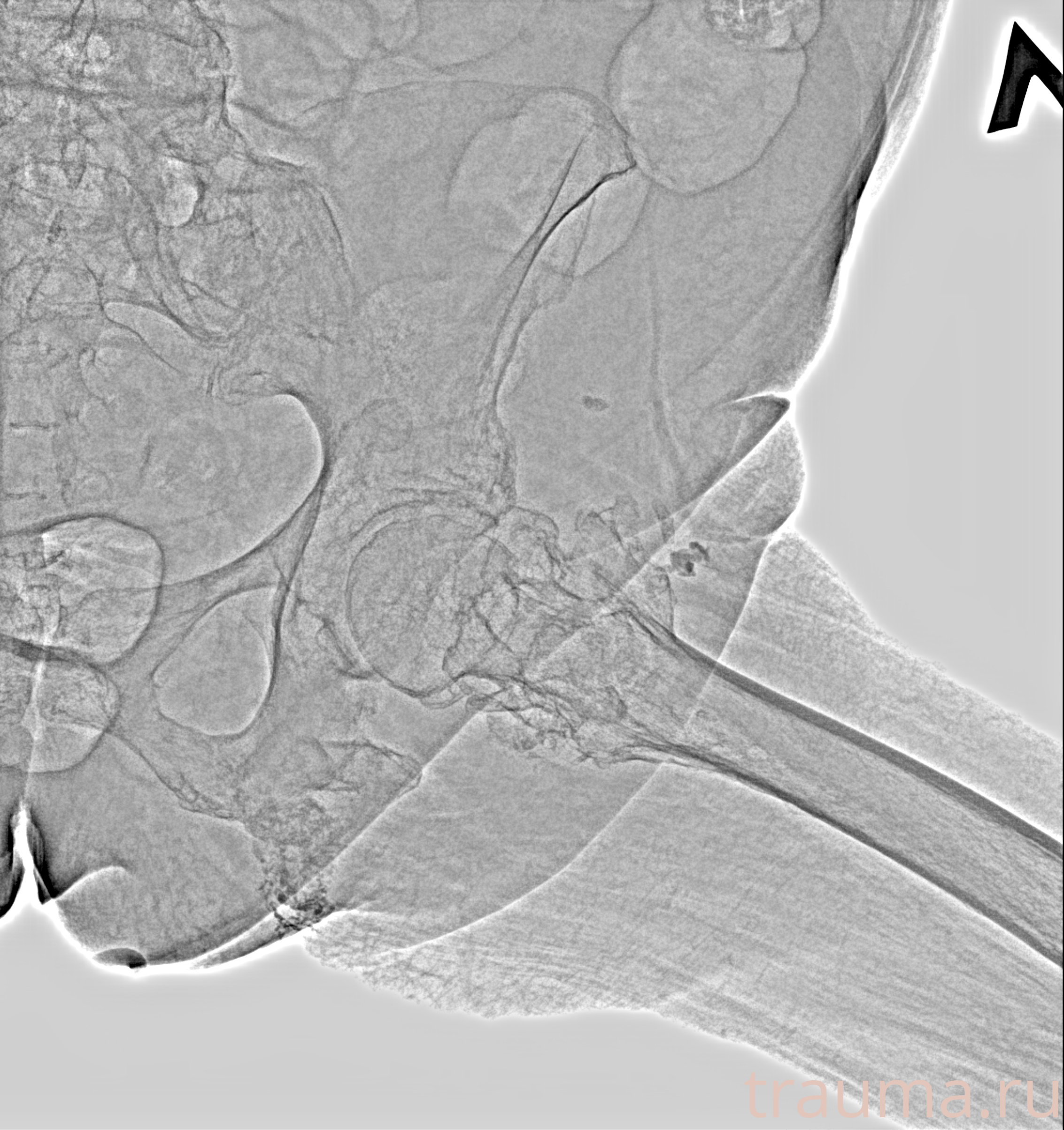 Рентген на дому: по вашему адресу приезжает врач-рентгенолог, травматолог-ортопед с мобильным рентгеновским аппаратом, проводит диагностику травмы или заболевания, делает необходимые рентгенограммы, дает рекомендации по дальнейшему лечению. Получить качественные снимки в домашних условиях возможно благодаря уникальной методике, разработанной МосРентген Центром для института  Склифосовского