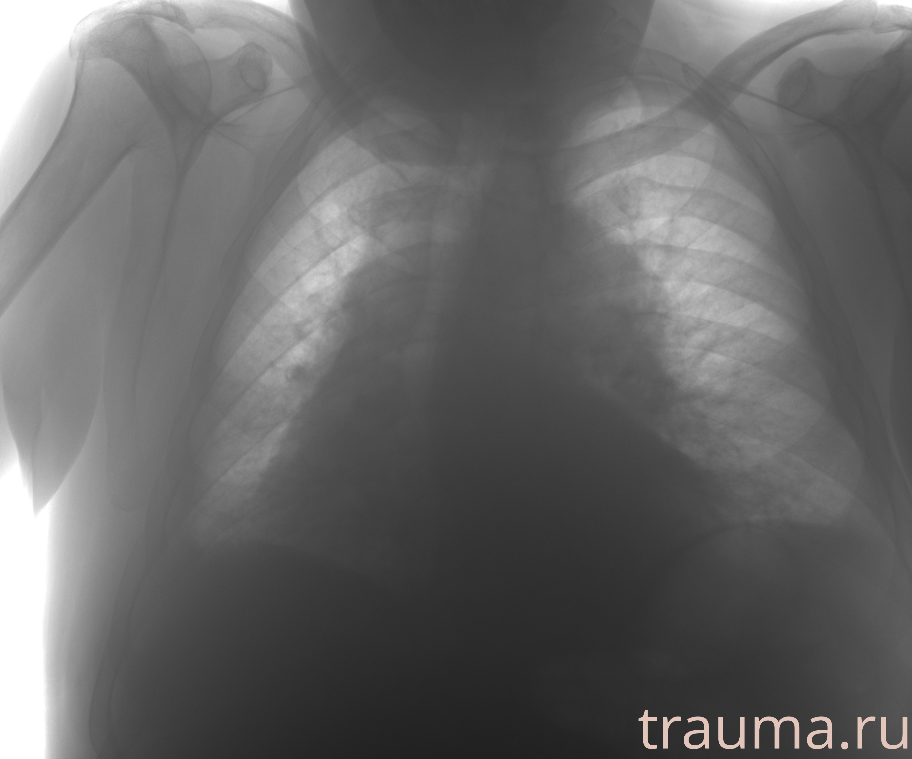 Рентген на дому: по вашему адресу приезжает врач-рентгенолог, травматолог-ортопед с мобильным рентгеновским аппаратом, проводит диагностику травмы или заболевания, делает необходимые рентгенограммы, дает рекомендации по дальнейшему лечению. Получить качественные снимки в домашних условиях возможно благодаря уникальной методике, разработанной МосРентген Центром для института  Склифосовского