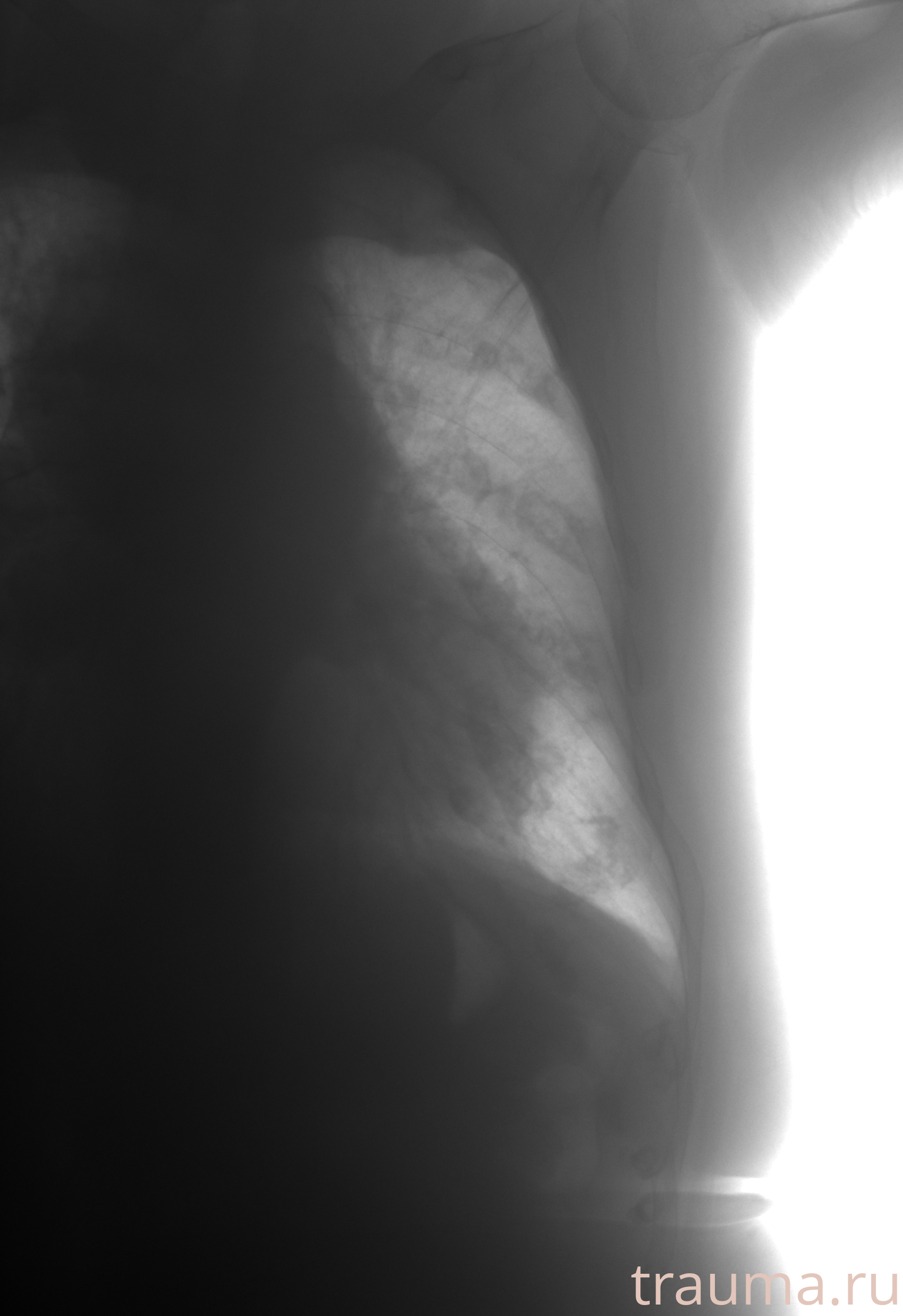 Рентген на дому: по вашему адресу приезжает врач-рентгенолог, травматолог-ортопед с мобильным рентгеновским аппаратом, проводит диагностику травмы или заболевания, делает необходимые рентгенограммы, дает рекомендации по дальнейшему лечению. Получить качественные снимки в домашних условиях возможно благодаря уникальной методике, разработанной МосРентген Центром для института  Склифосовского