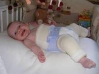 Причины осложнений при лечении детей первого года жизни с врожденным вывихом бедра