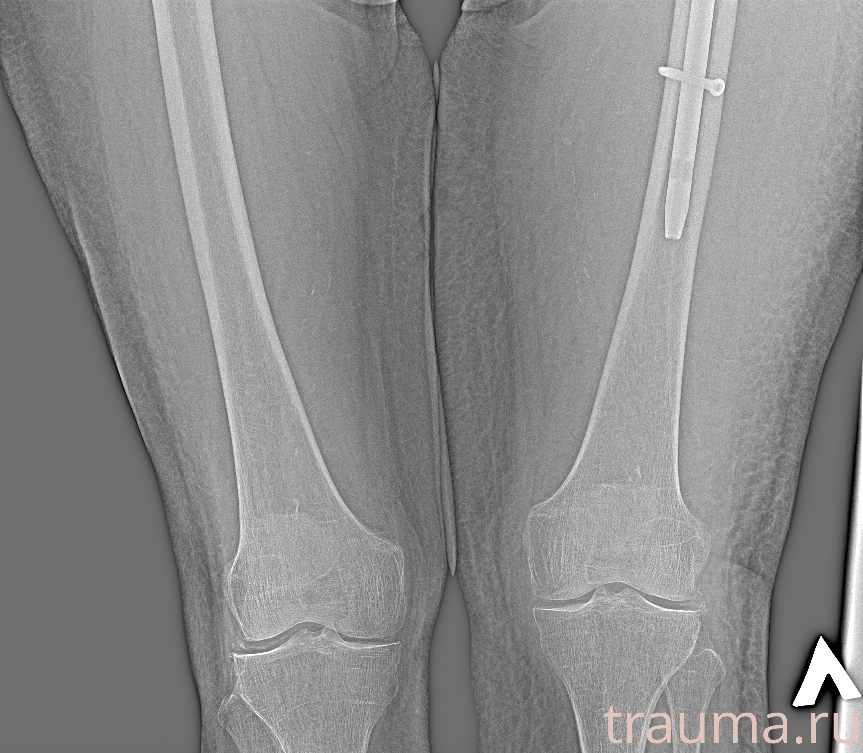 Рентген на дому: по вашему адресу приезжает врач-рентгенолог, травматолог-ортопед с мобильным рентгеновским аппаратом, проводит диагностику травмы или заболевания, делает необходимые рентгенограммы, дает рекомендации по дальнейшему лечению. Получить качественные снимки в домашних условиях возможно благодаря уникальной методике, разработанной МосРентген Центром для института  Склифосовского