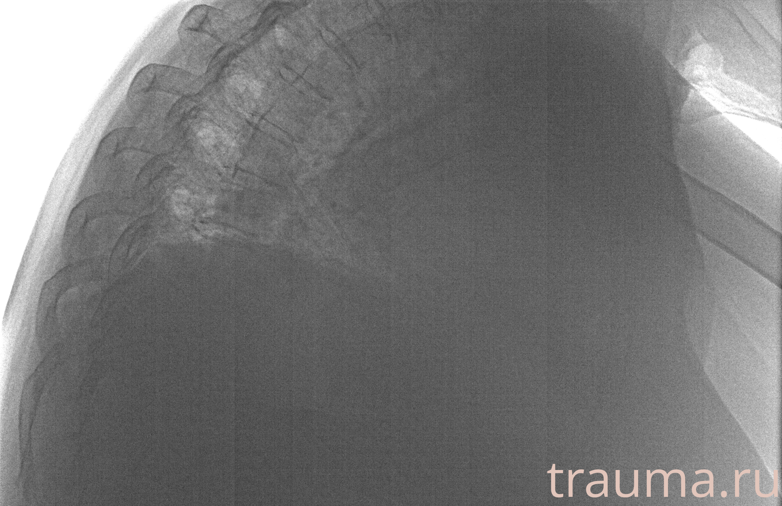 Рентген на дому: по вашему адресу приезжает врач-рентгенолог, травматолог-ортопед с мобильным рентгеновским аппаратом, проводит диагностику травмы или заболевания, делает необходимые рентгенограммы, дает рекомендации по дальнейшему лечению. Получить качественные снимки в домашних условиях возможно благодаря уникальной методике, разработанной МосРентген Центром для института  Склифосовского