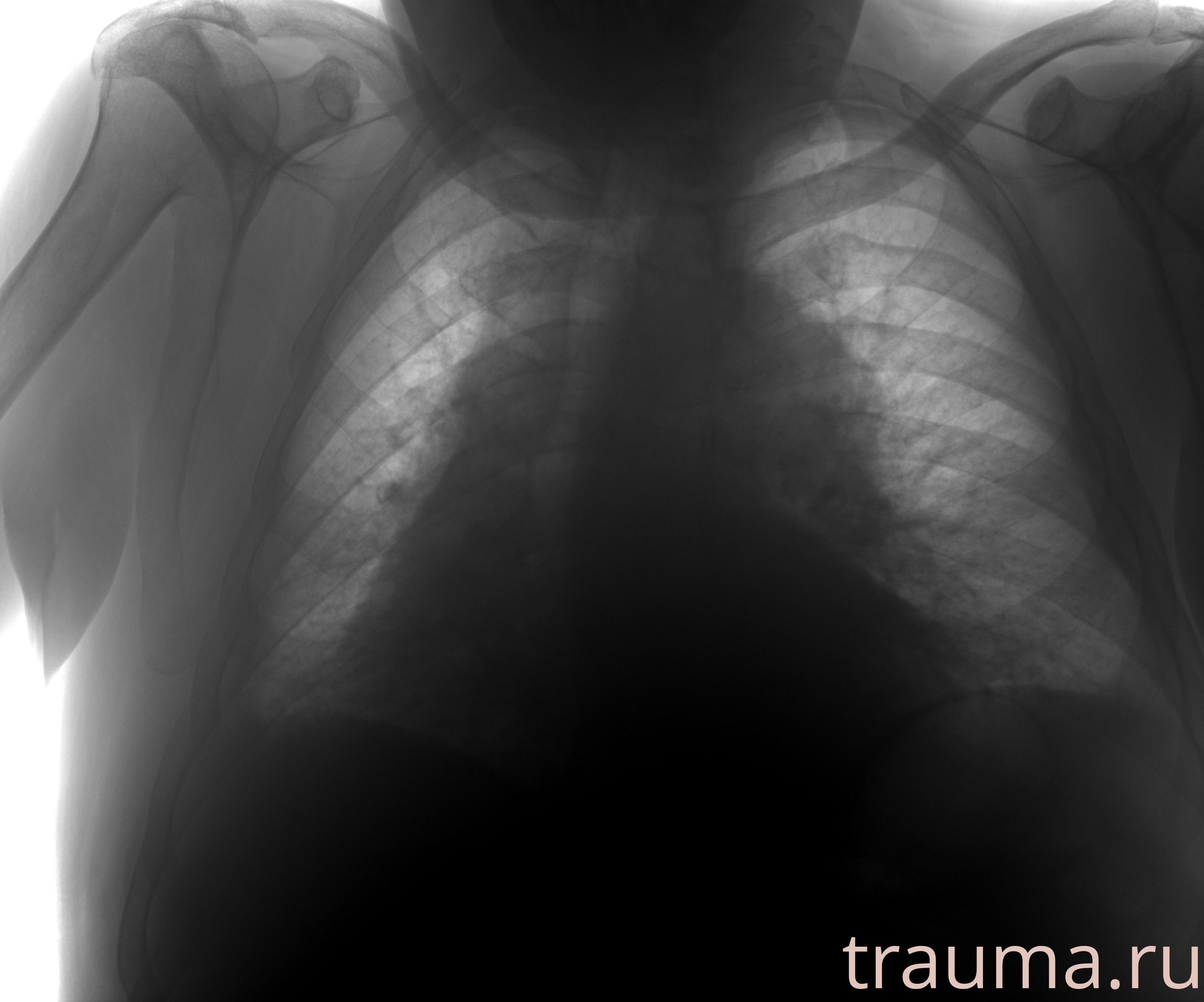 Рентген на дому: по вашему адресу приезжает врач-рентгенолог, травматолог-ортопед с мобильным рентгеновским аппаратом, проводит диагностику травмы или заболевания, делает необходимые рентгенограммы, дает рекомендации по дальнейшему лечению. Получить качественные снимки в домашних условиях возможно благодаря уникальной методике, разработанной МосРентген Центром для института  Склифосовского